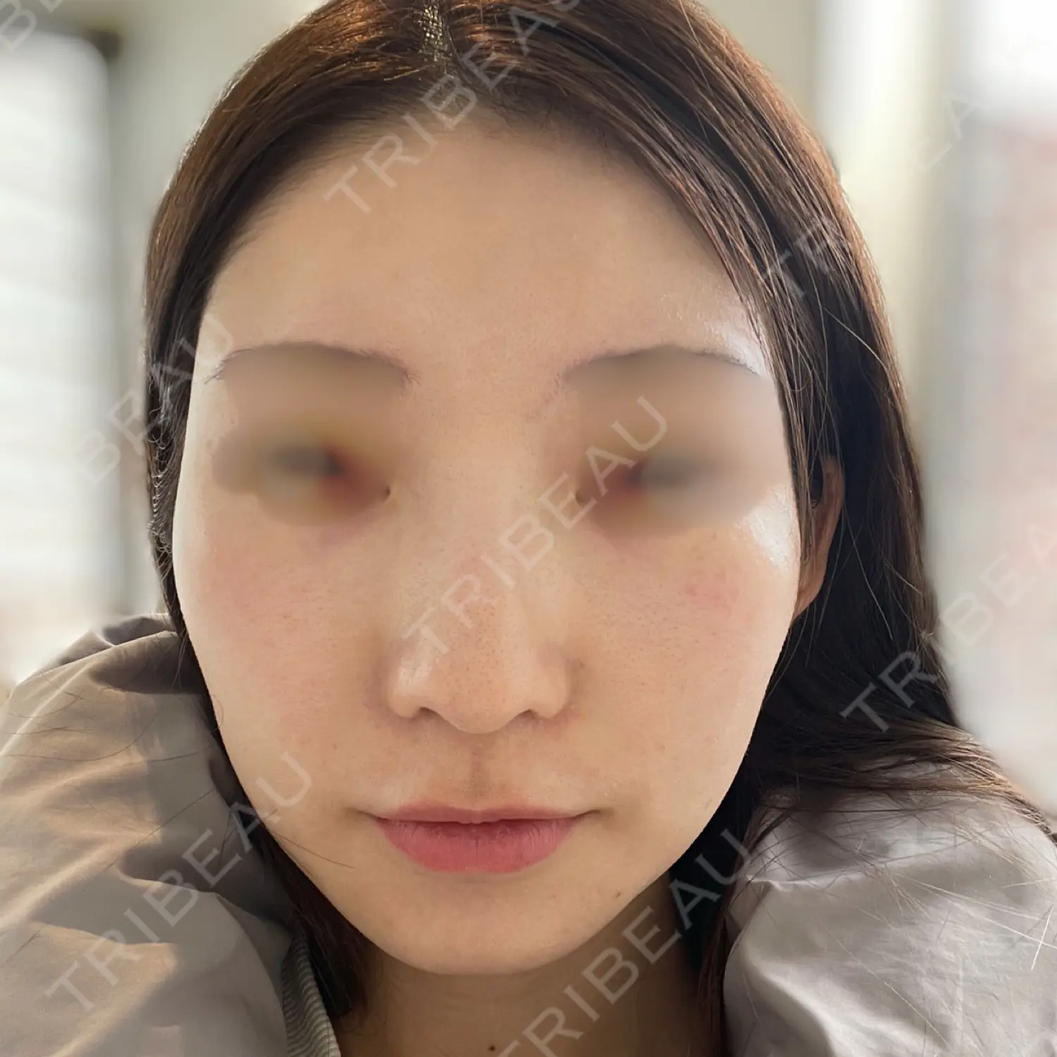 施術後の写真