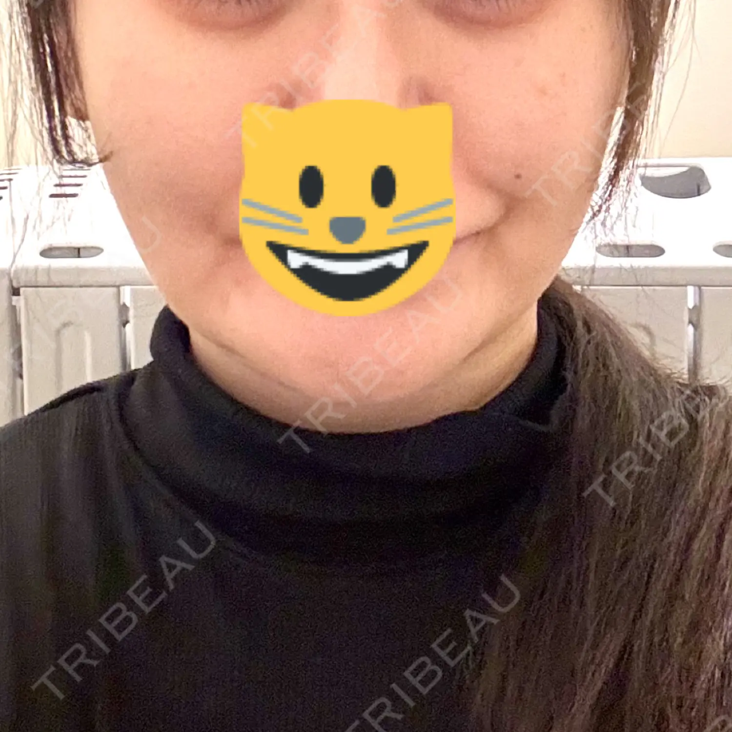 施術後の写真