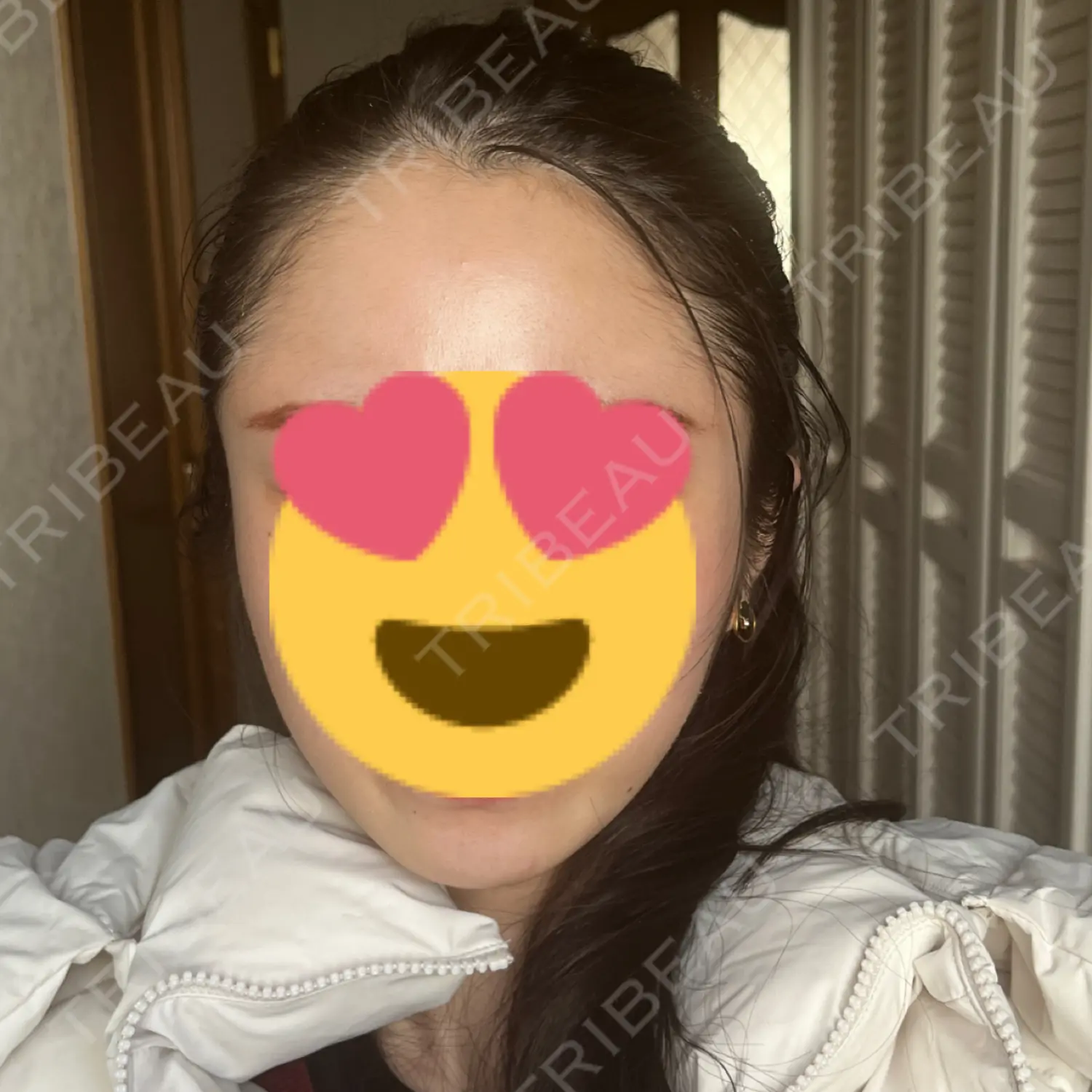 施術後の写真