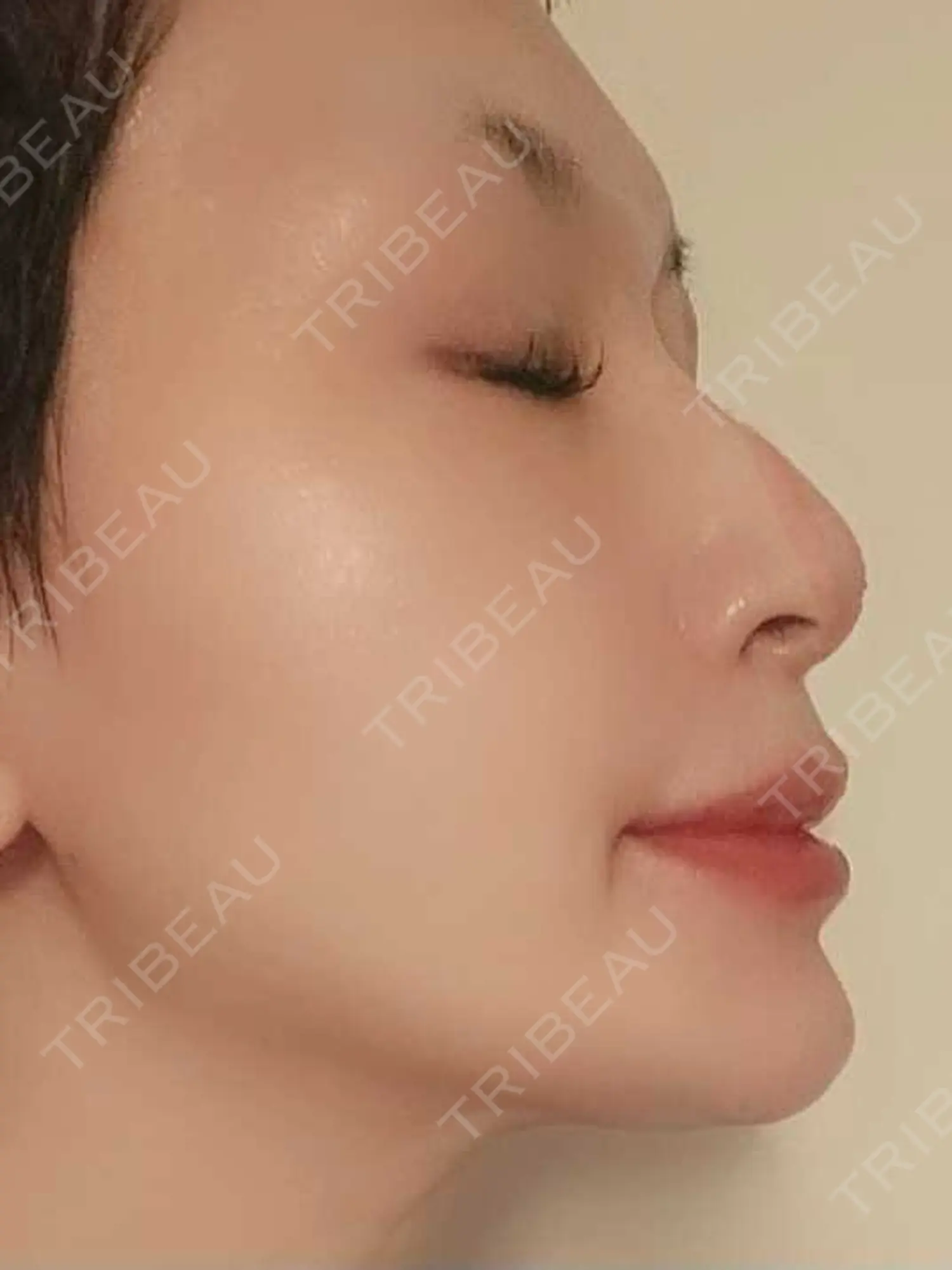 施術後の写真