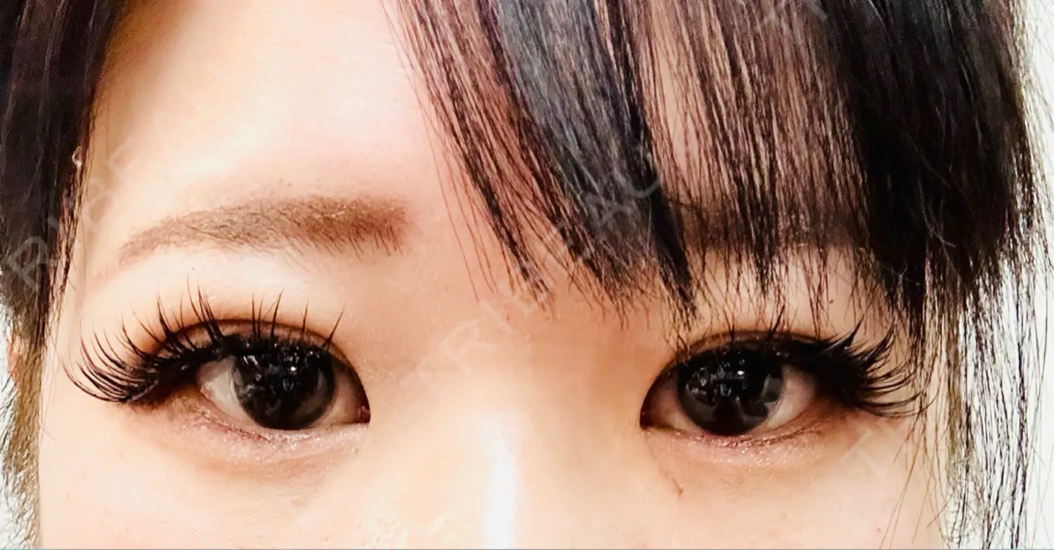 施術後の写真