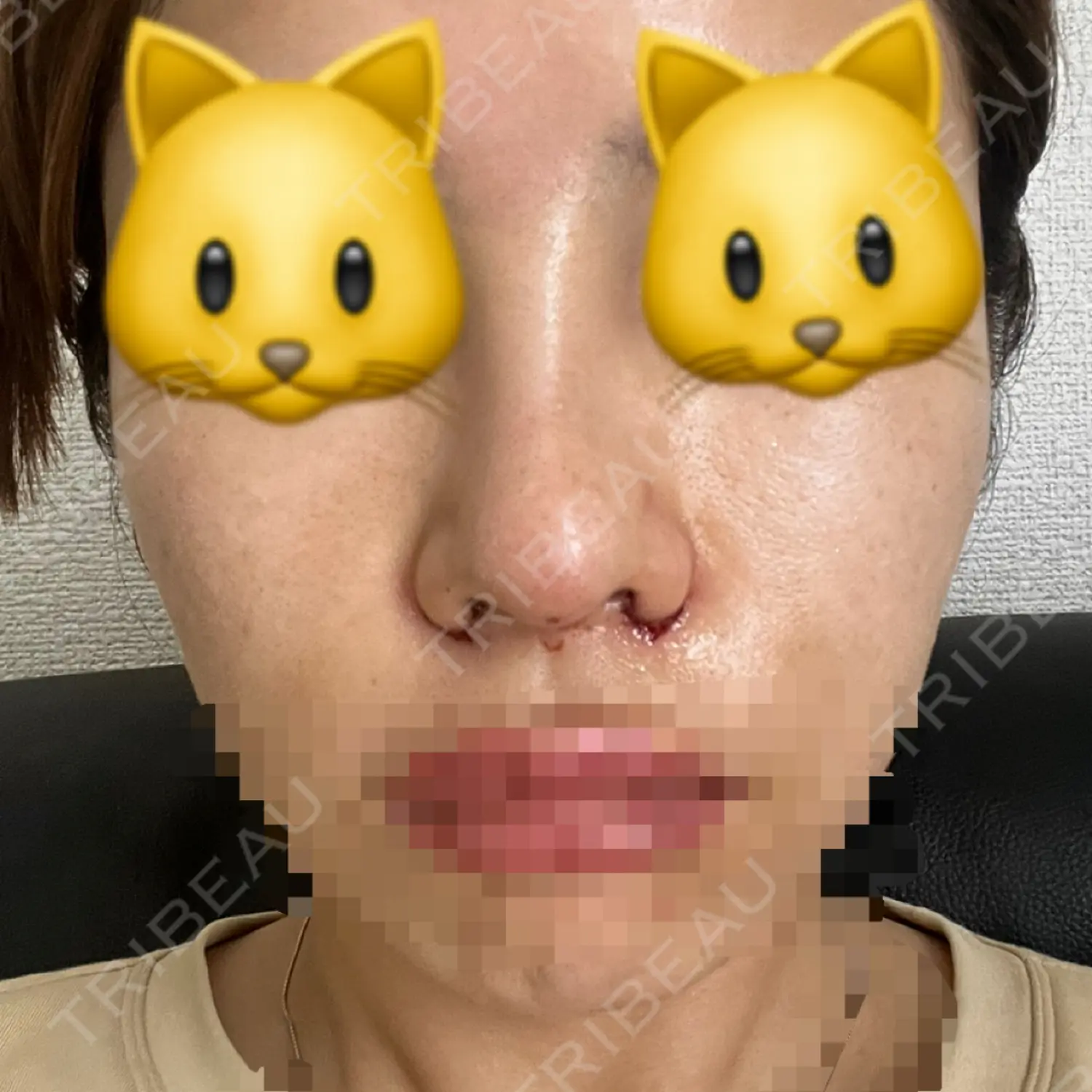 施術後の写真