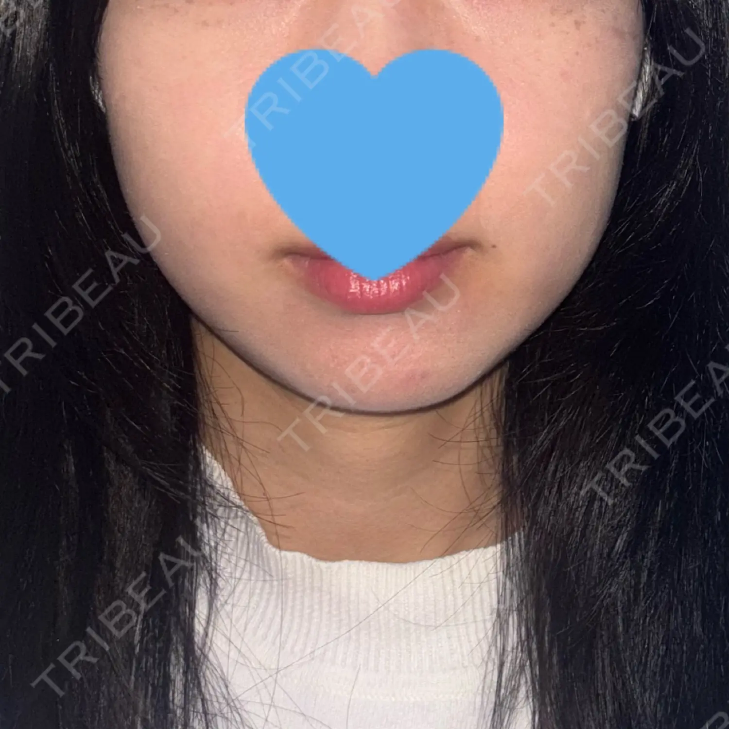 施術後の写真