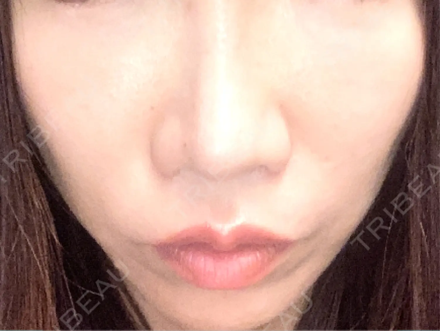 施術後の写真