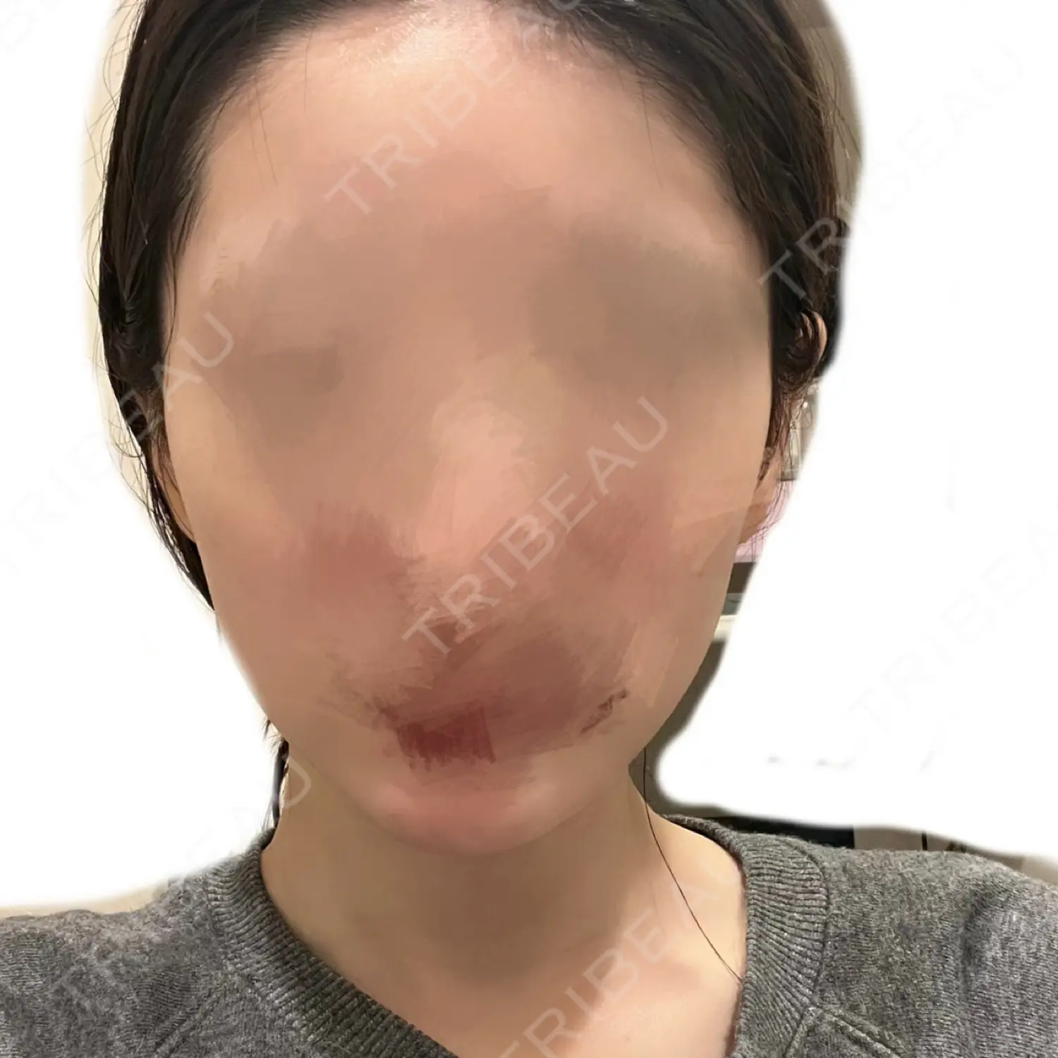 施術後の写真
