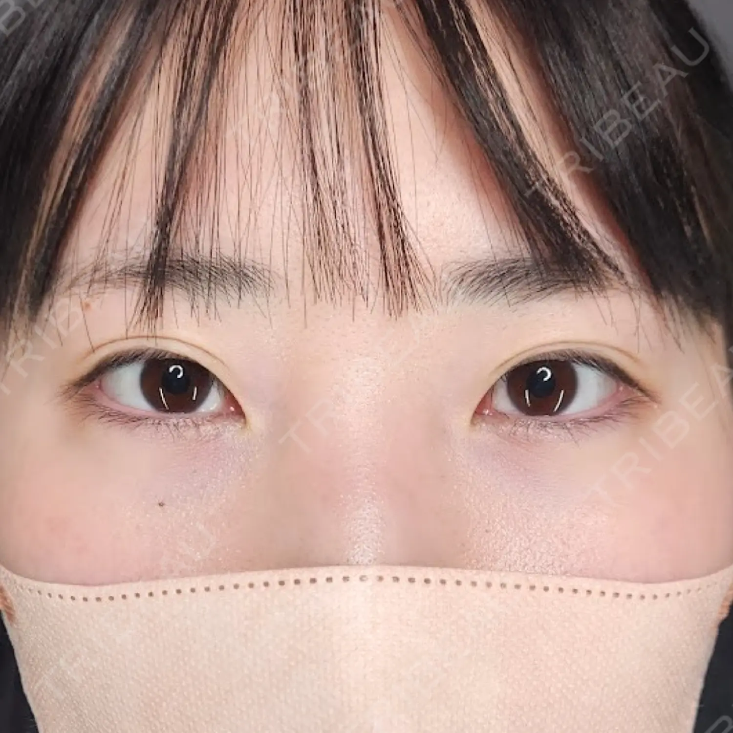 施術後の写真