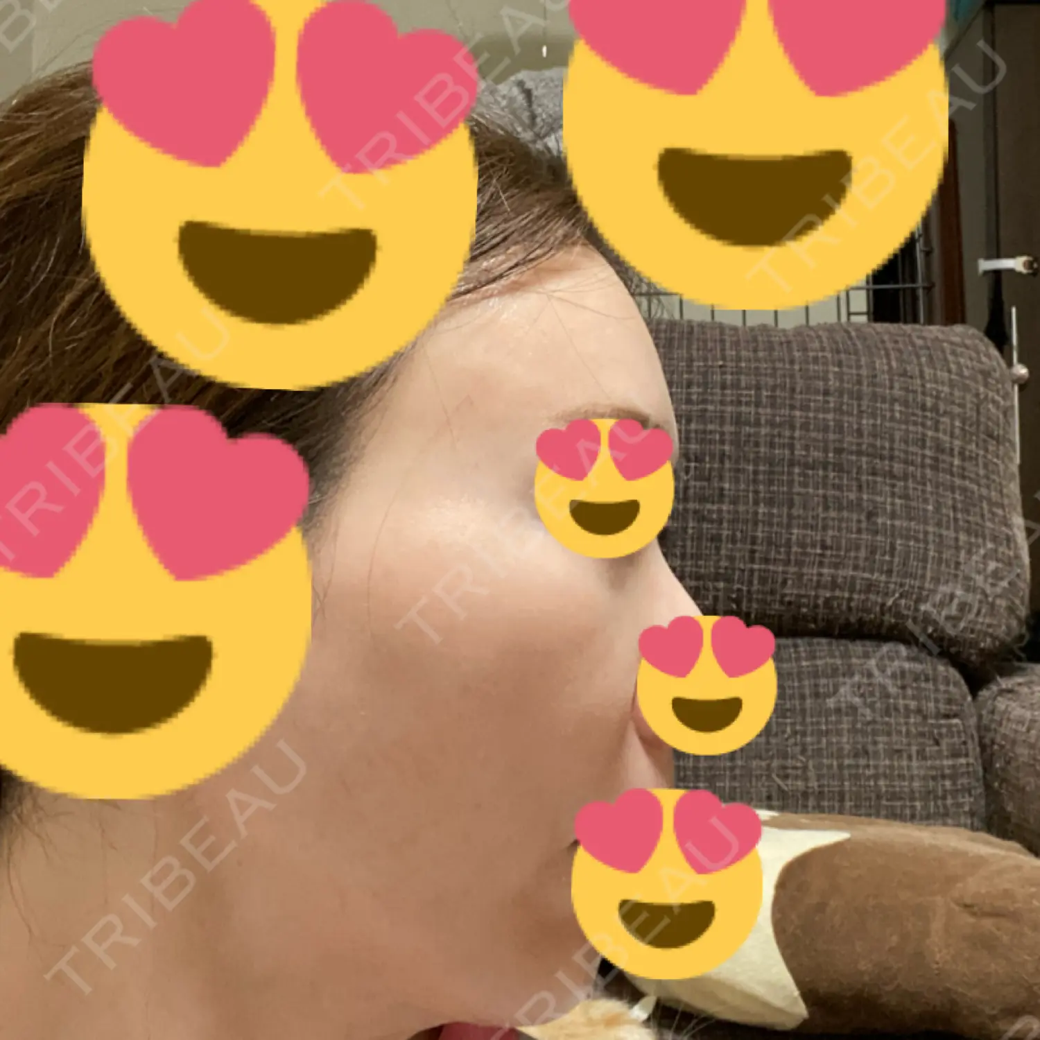 施術後の写真