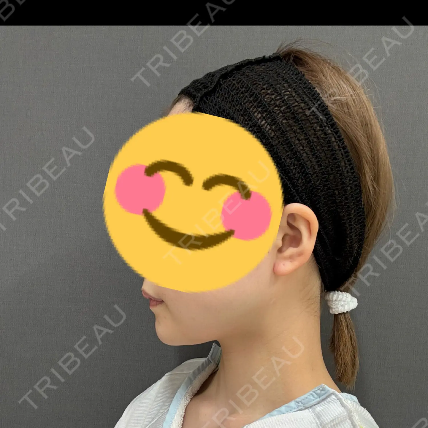 施術後の写真
