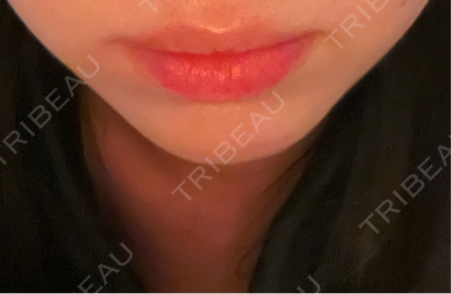 施術後の写真