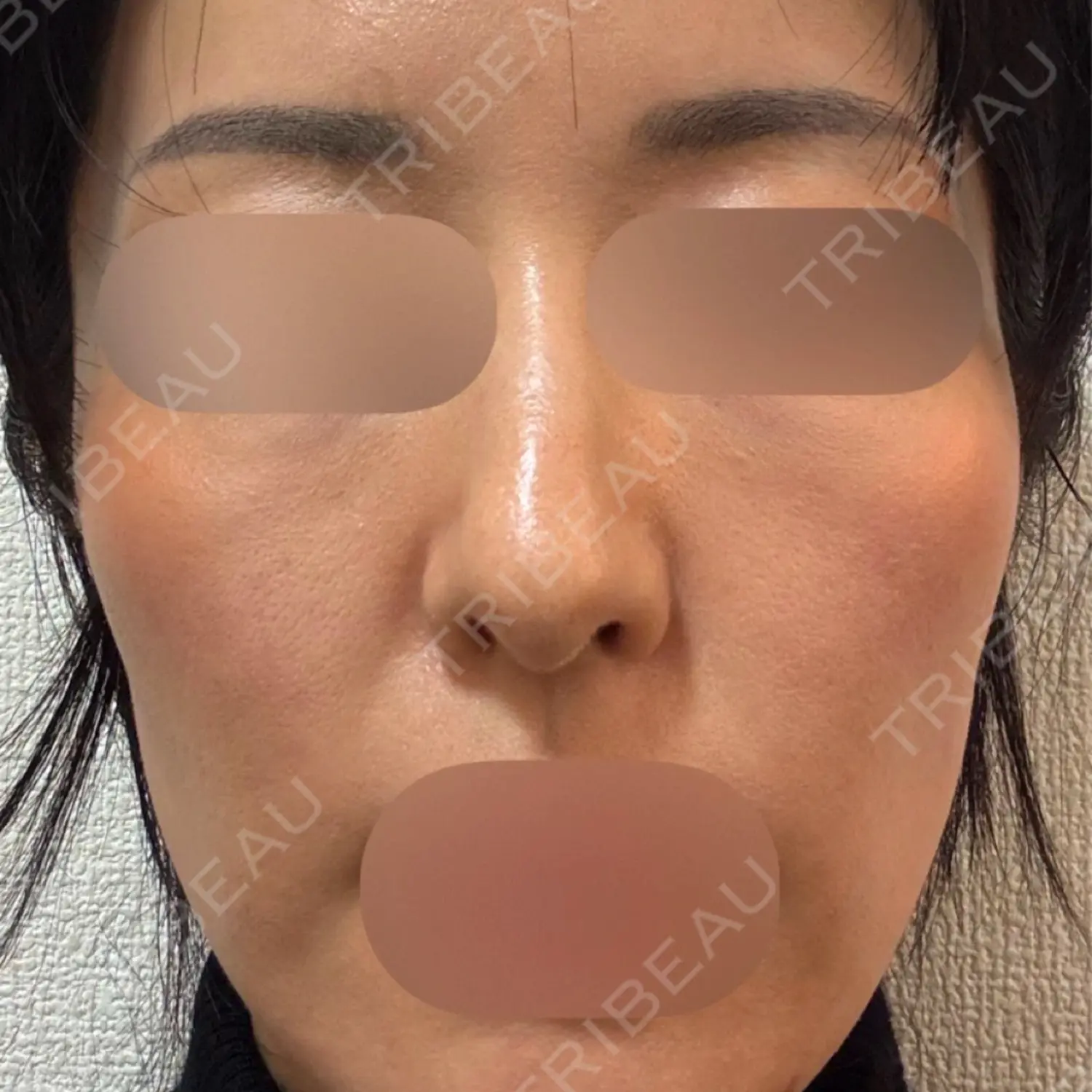 施術後の写真