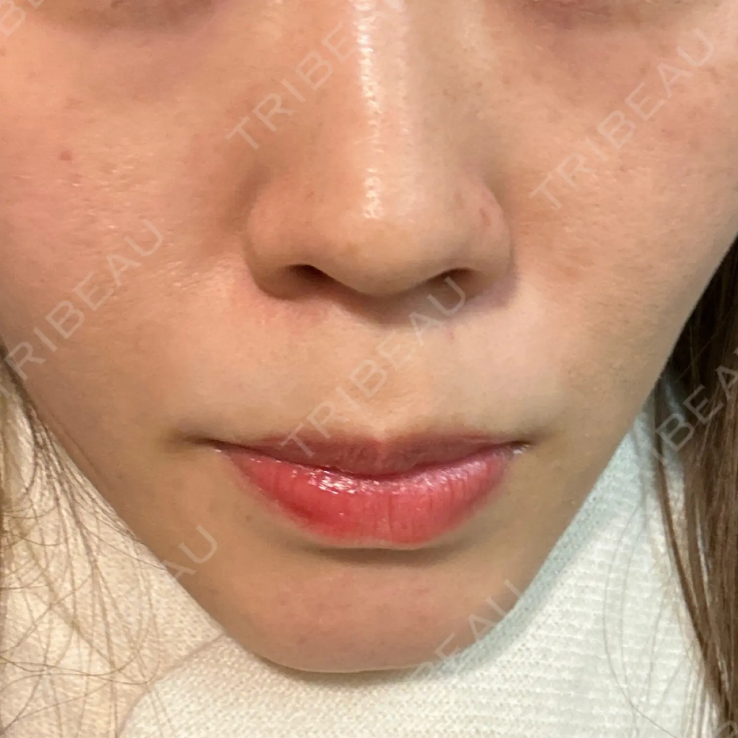 施術後の写真