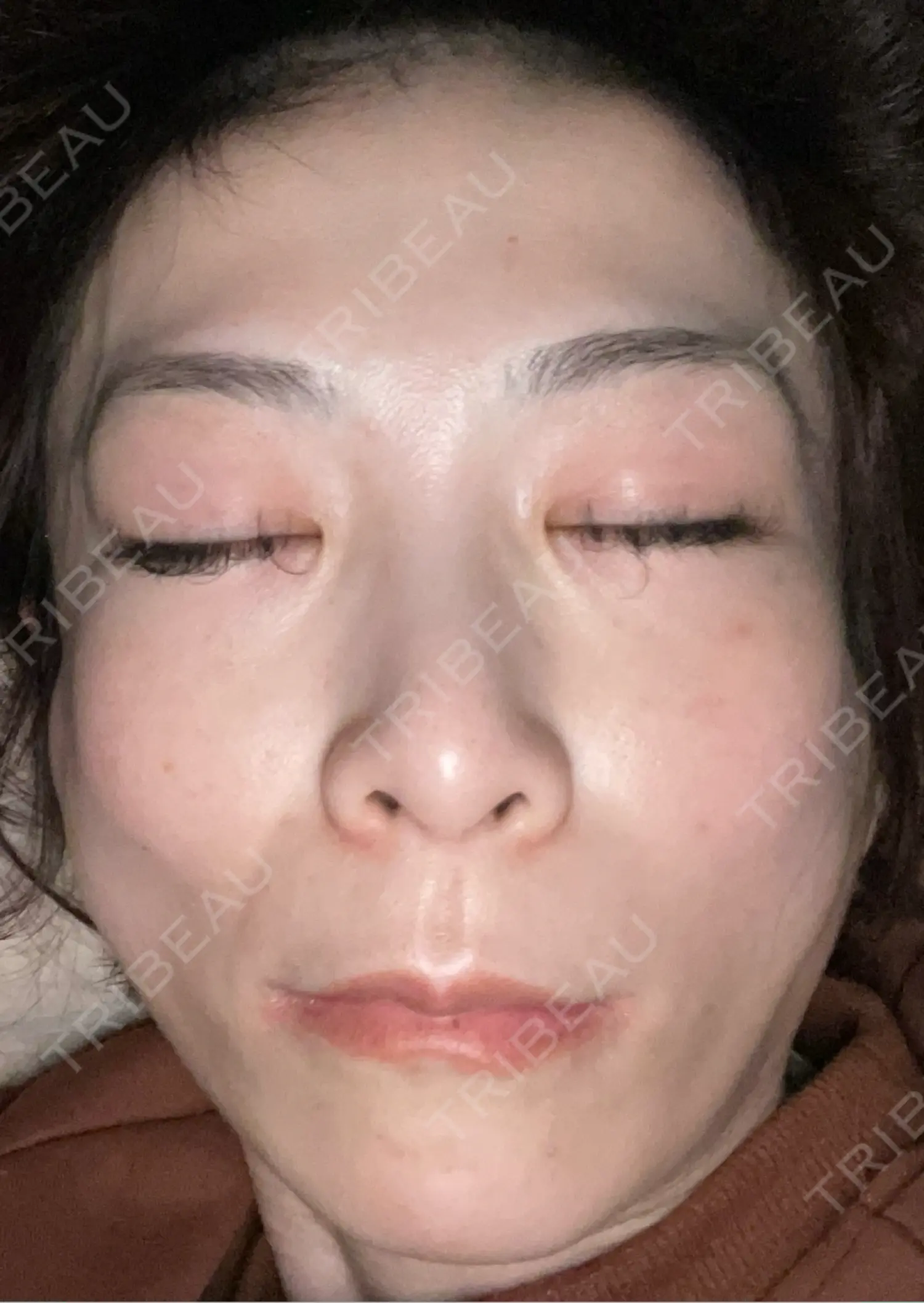 施術後の写真