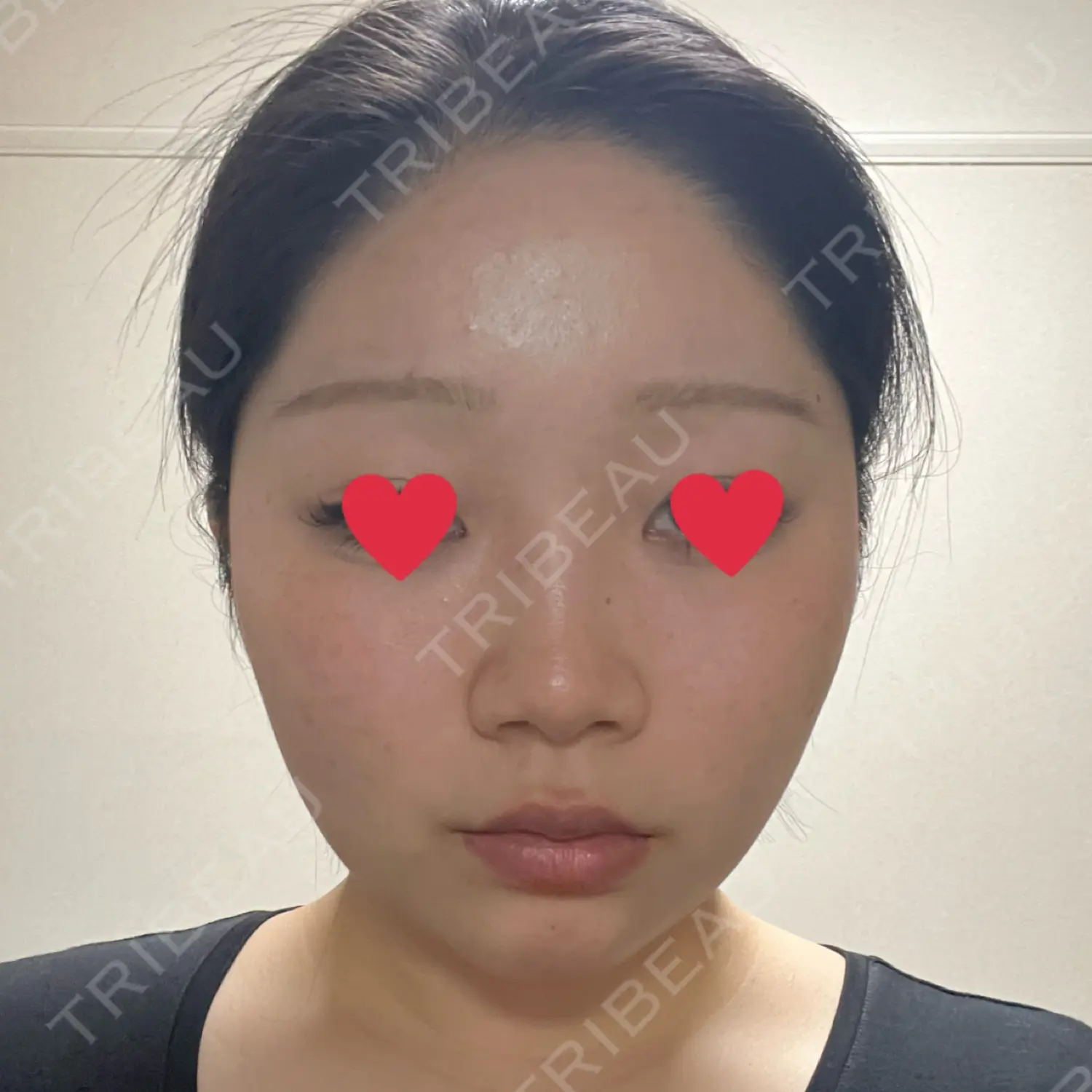 施術後の写真