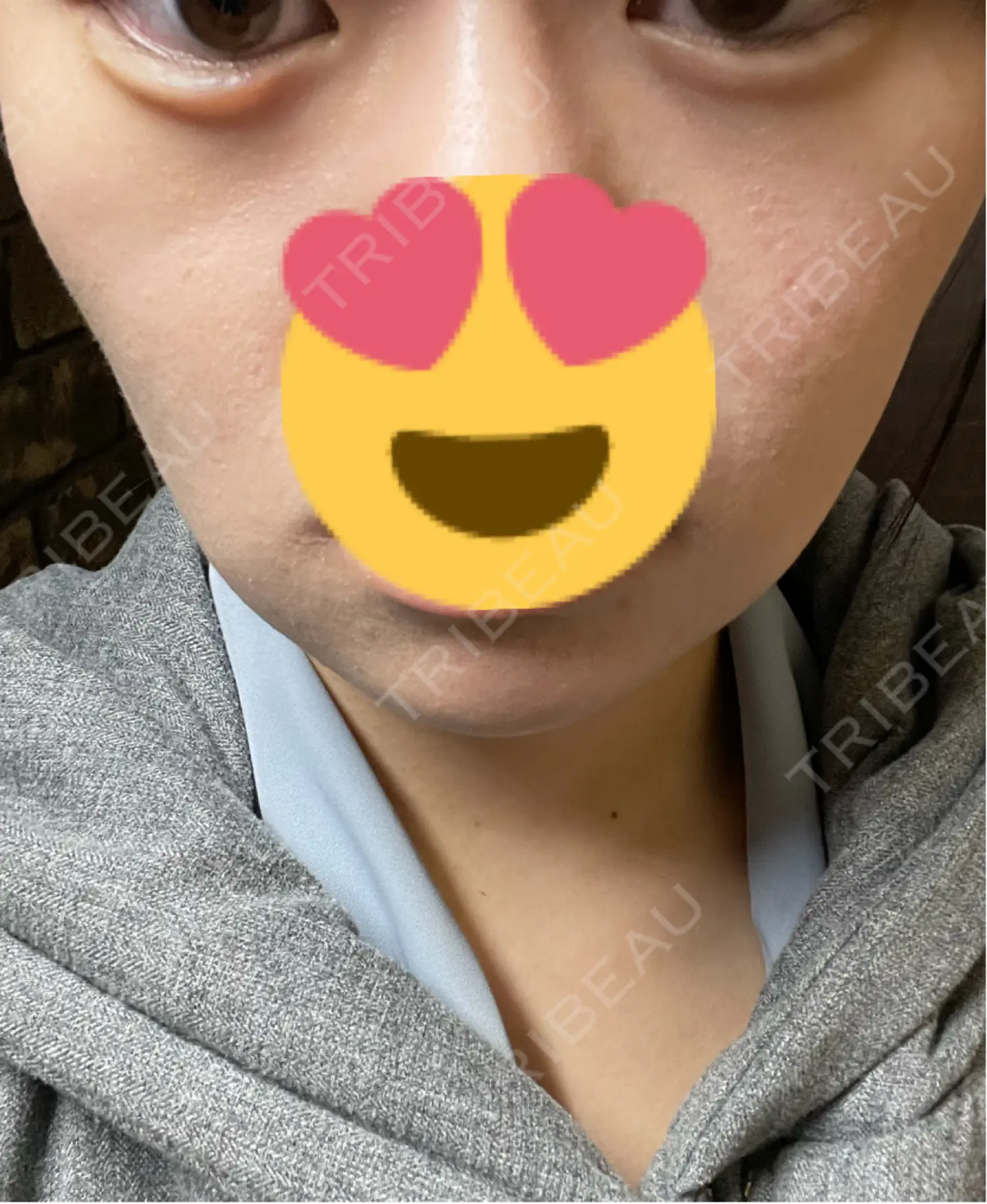 施術後の写真