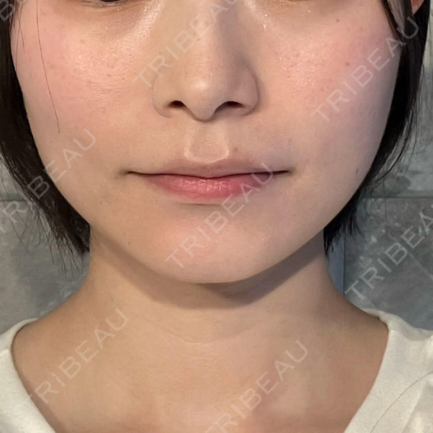 施術後の写真