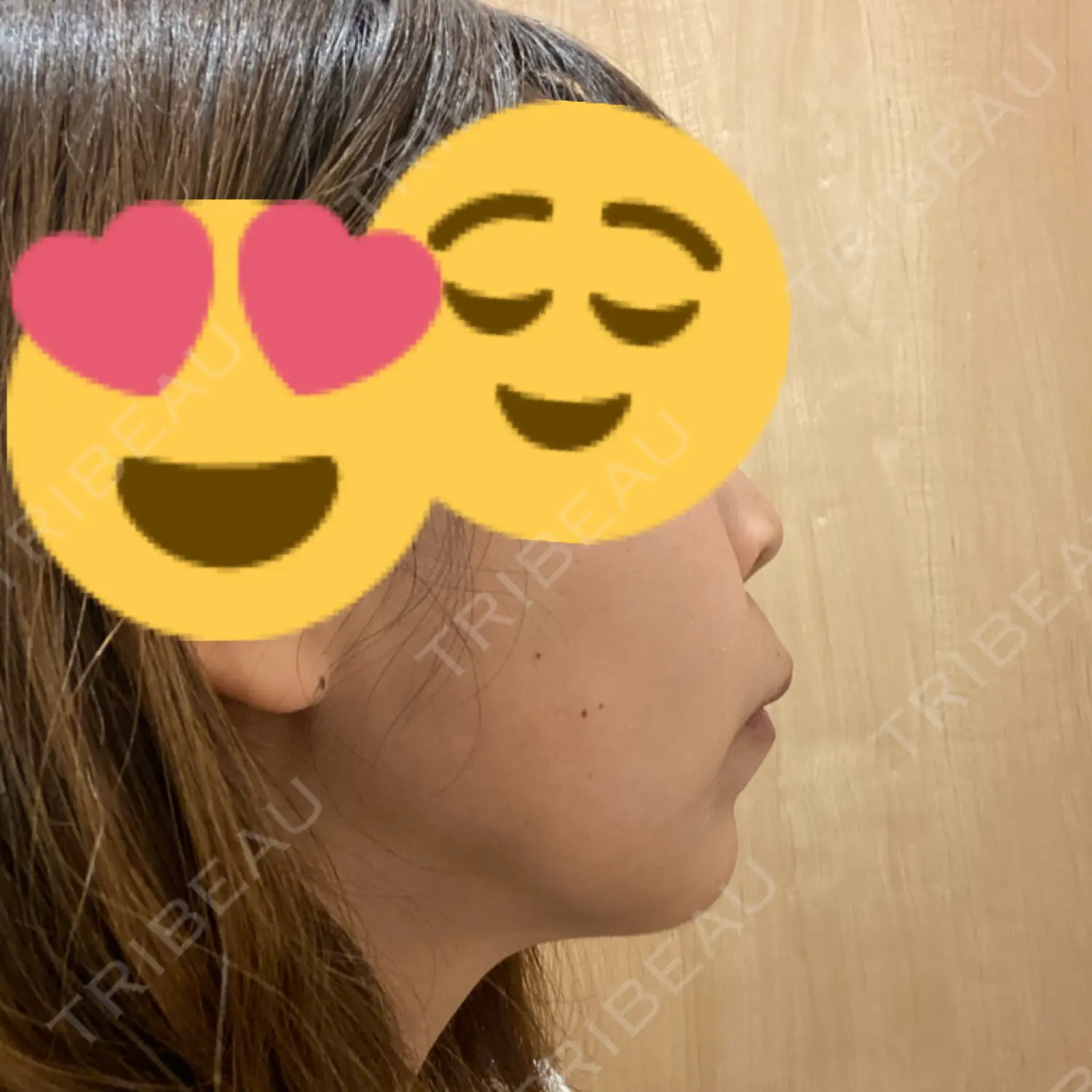 施術後の写真