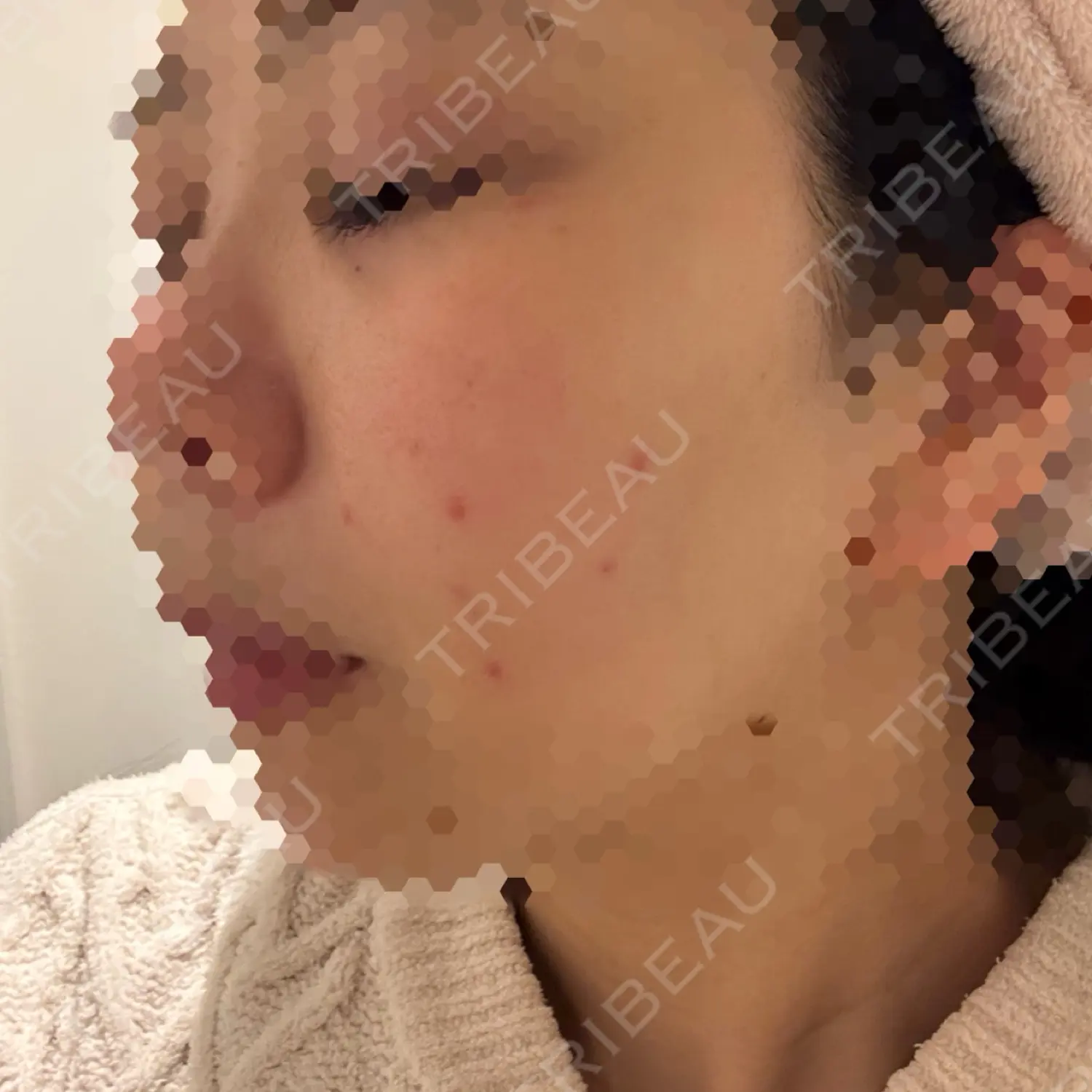 施術後の写真