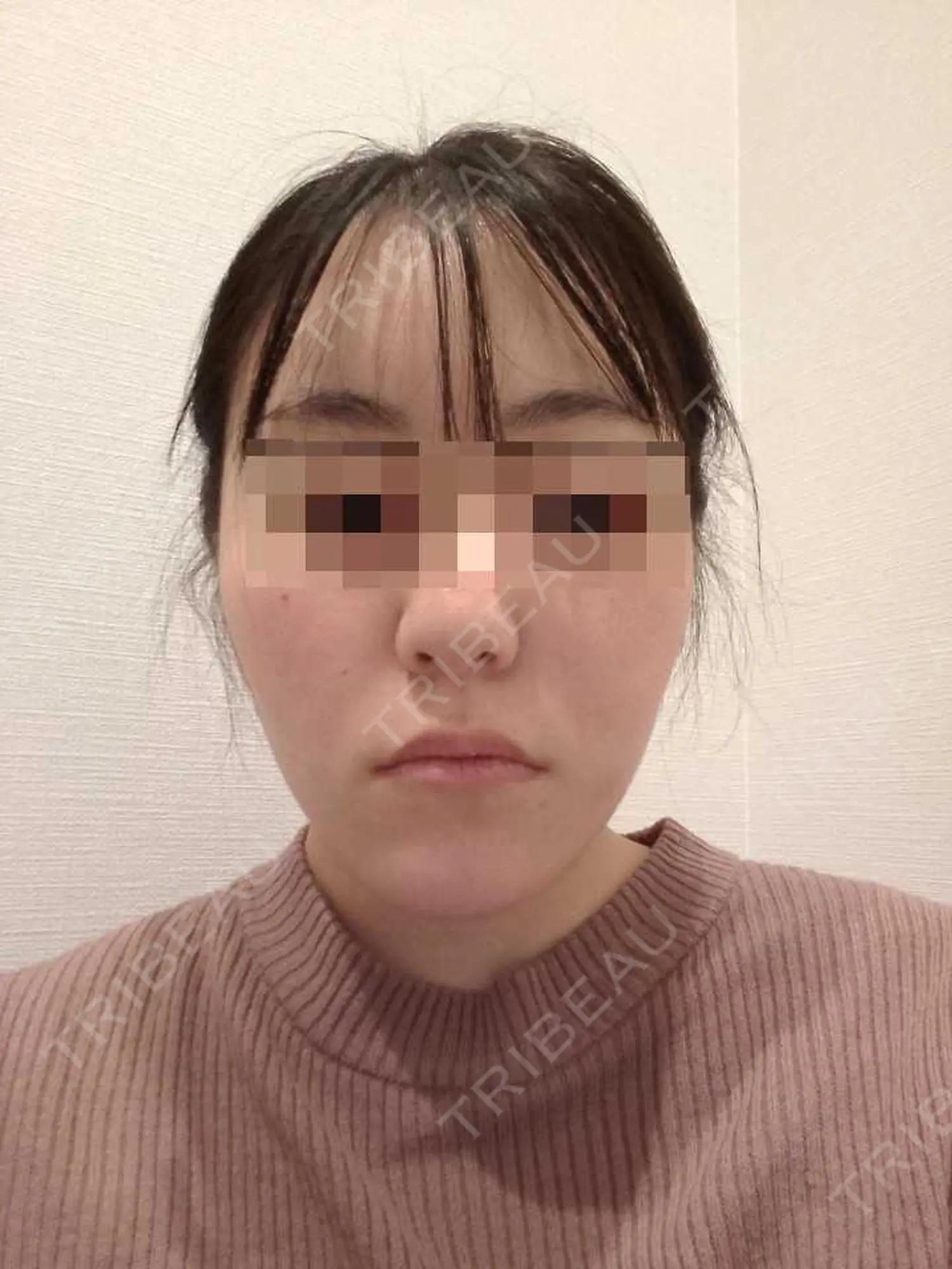 施術後の写真