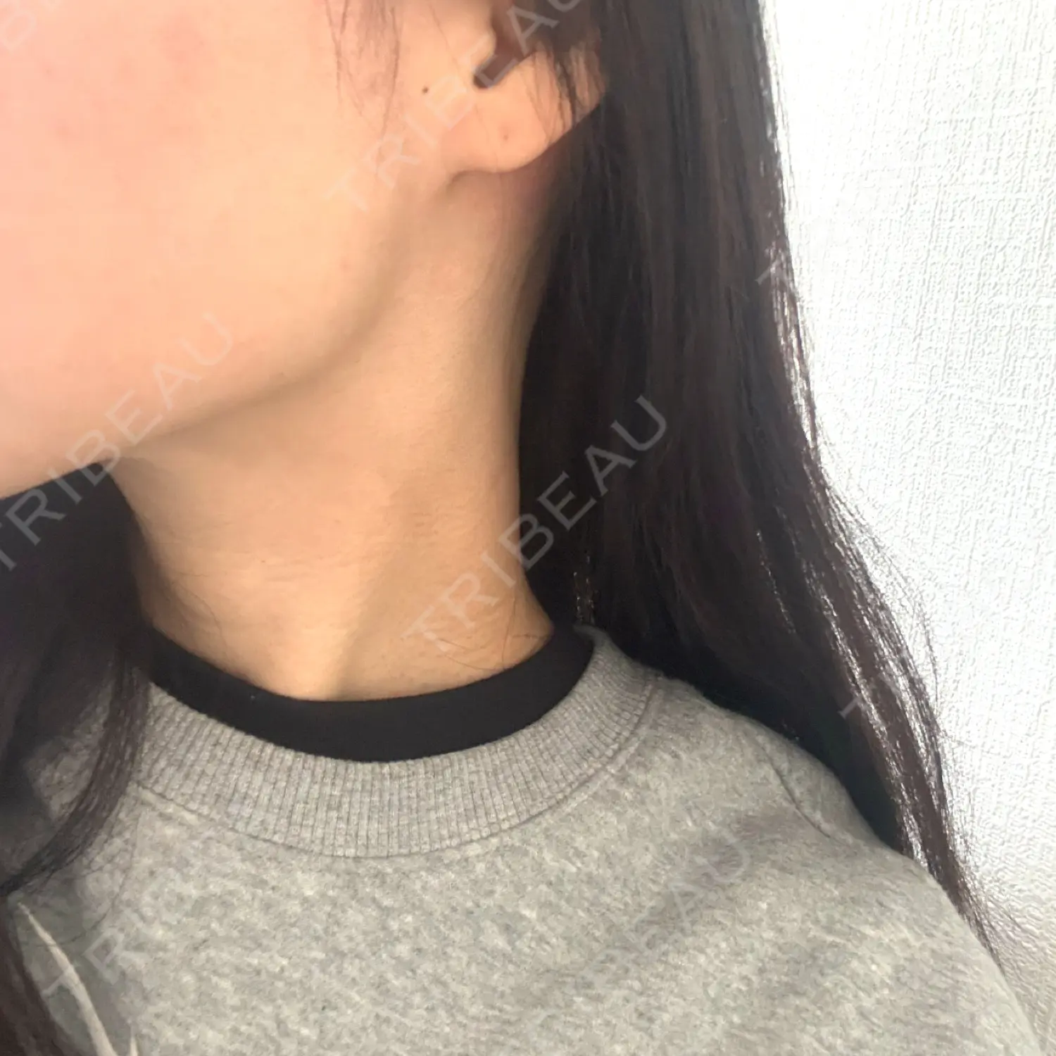 施術後の写真