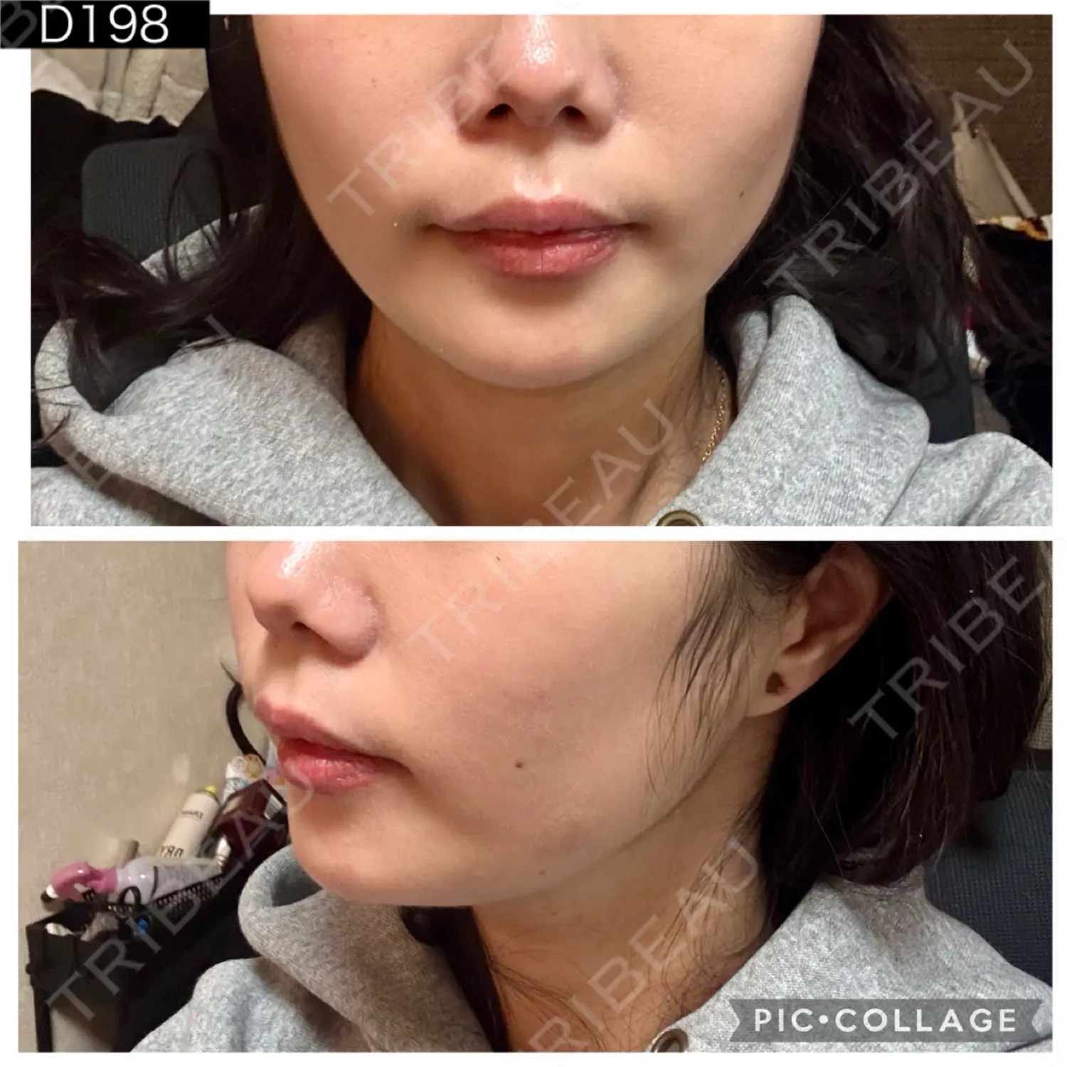 施術後の写真