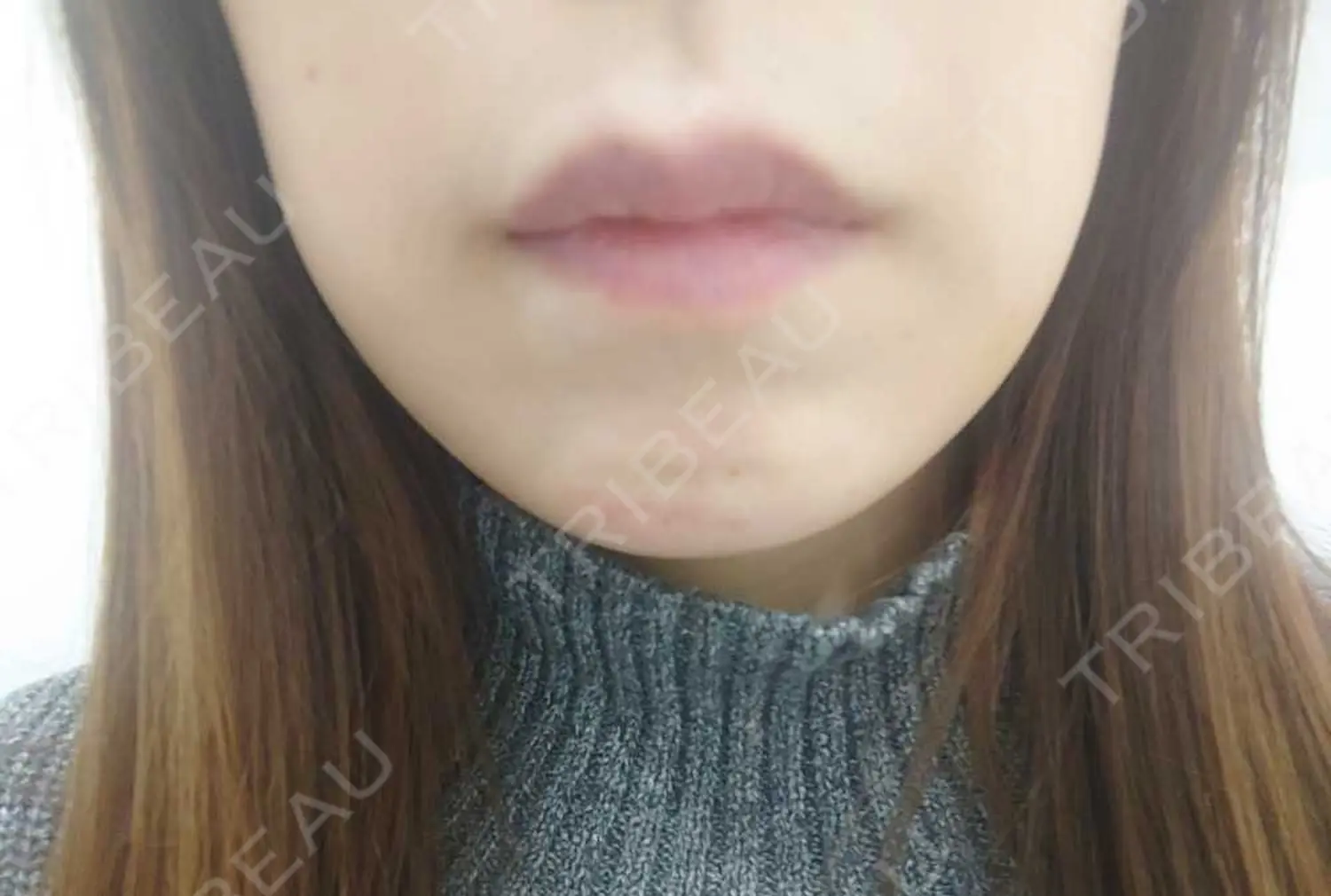 施術後の写真