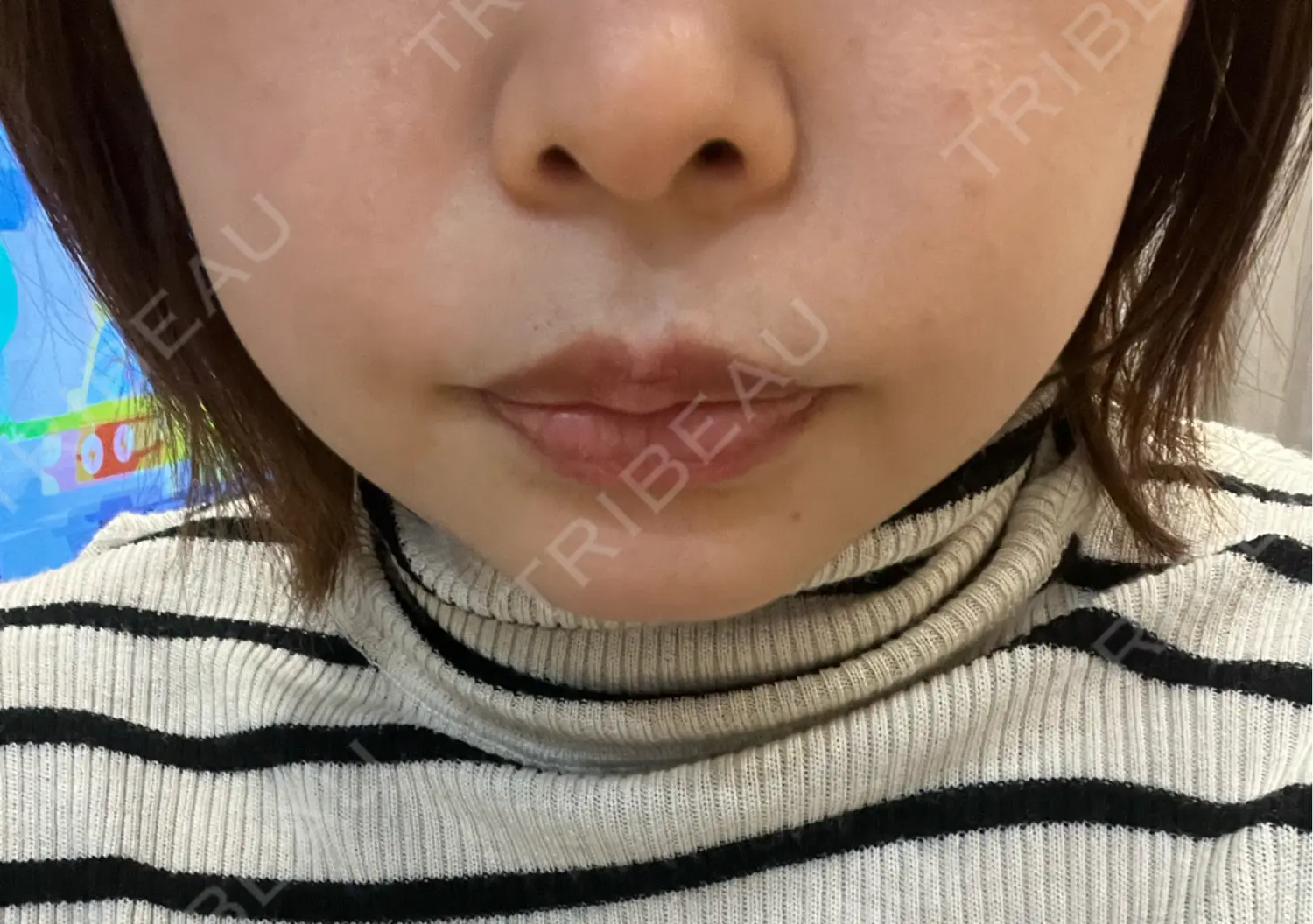 施術後の写真