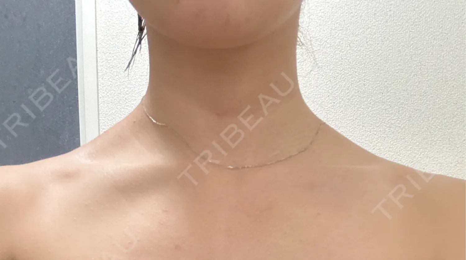 施術後の写真
