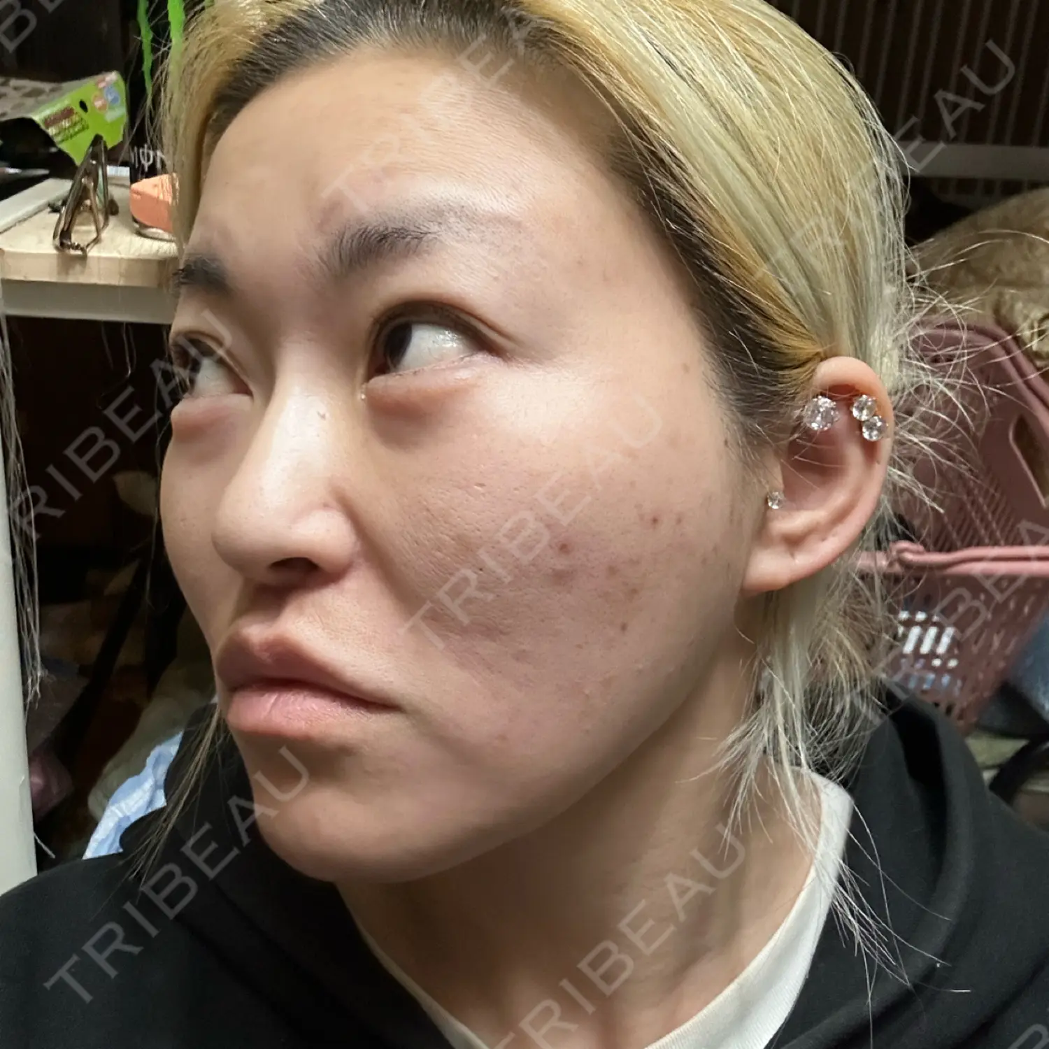 施術後の写真