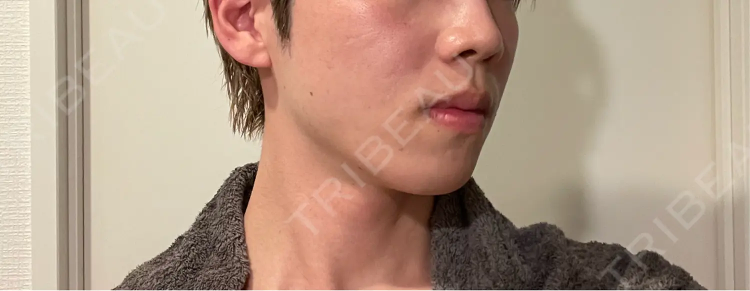 施術後の写真