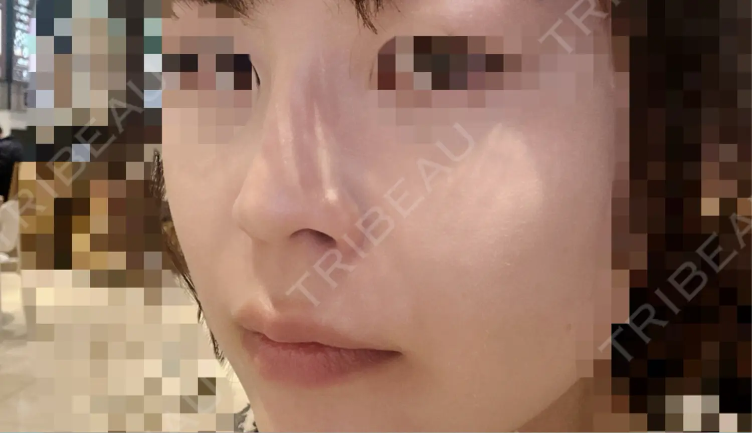 施術後の写真