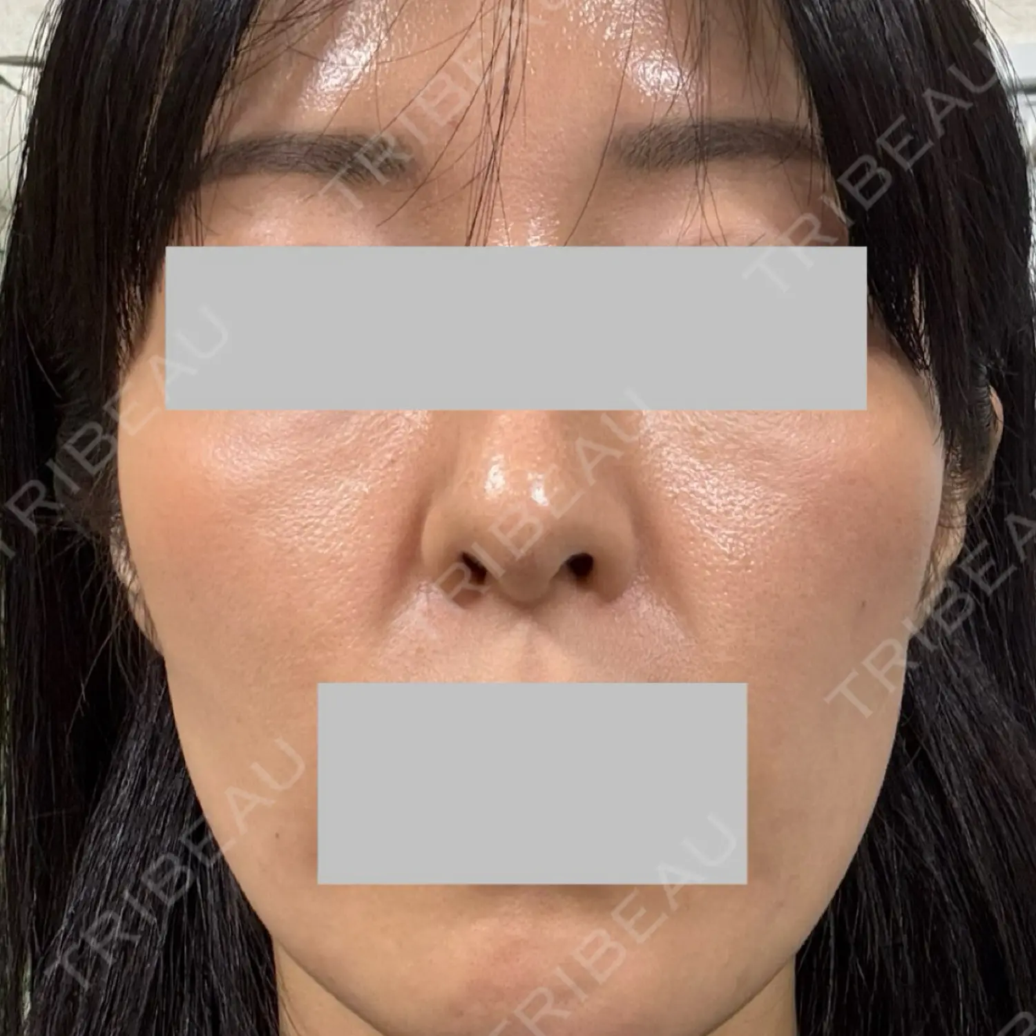 施術後の写真