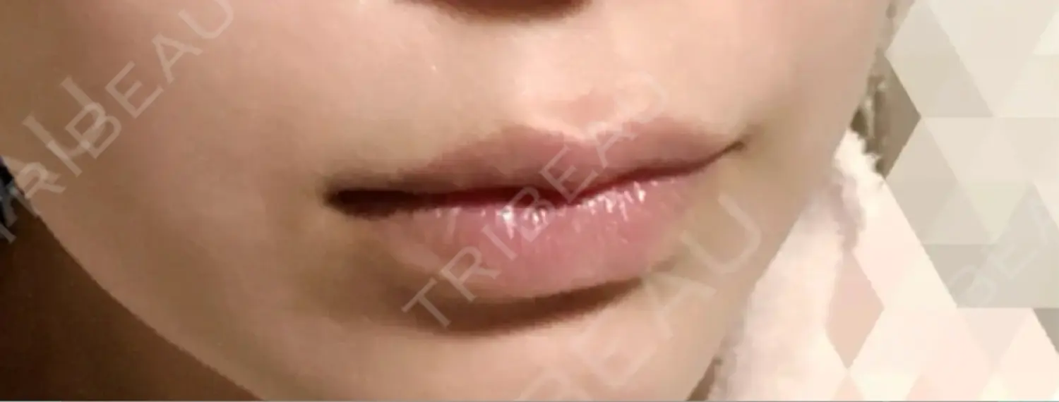施術後の写真