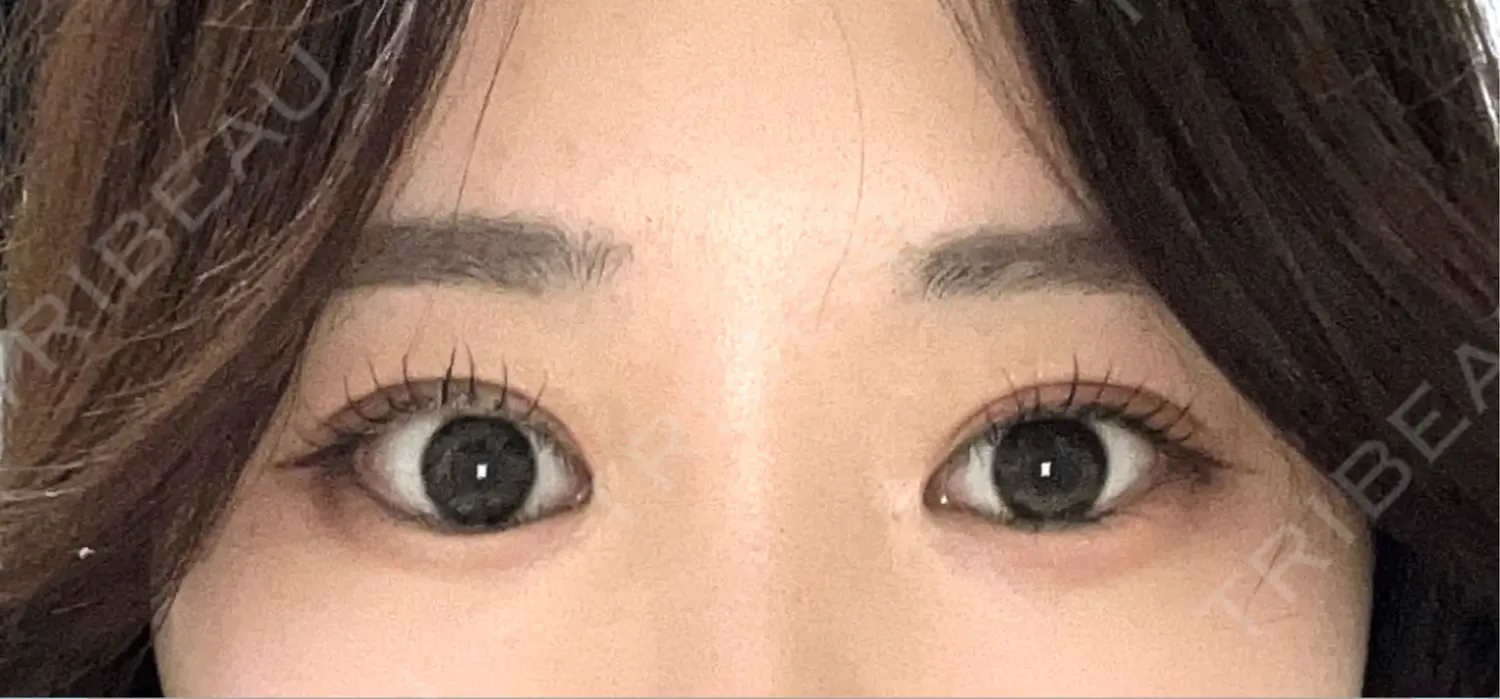 施術後の写真
