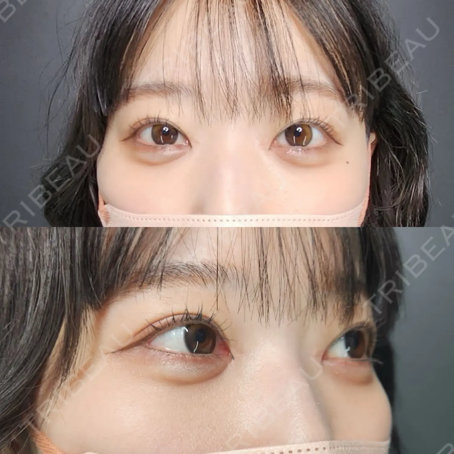 施術後の写真