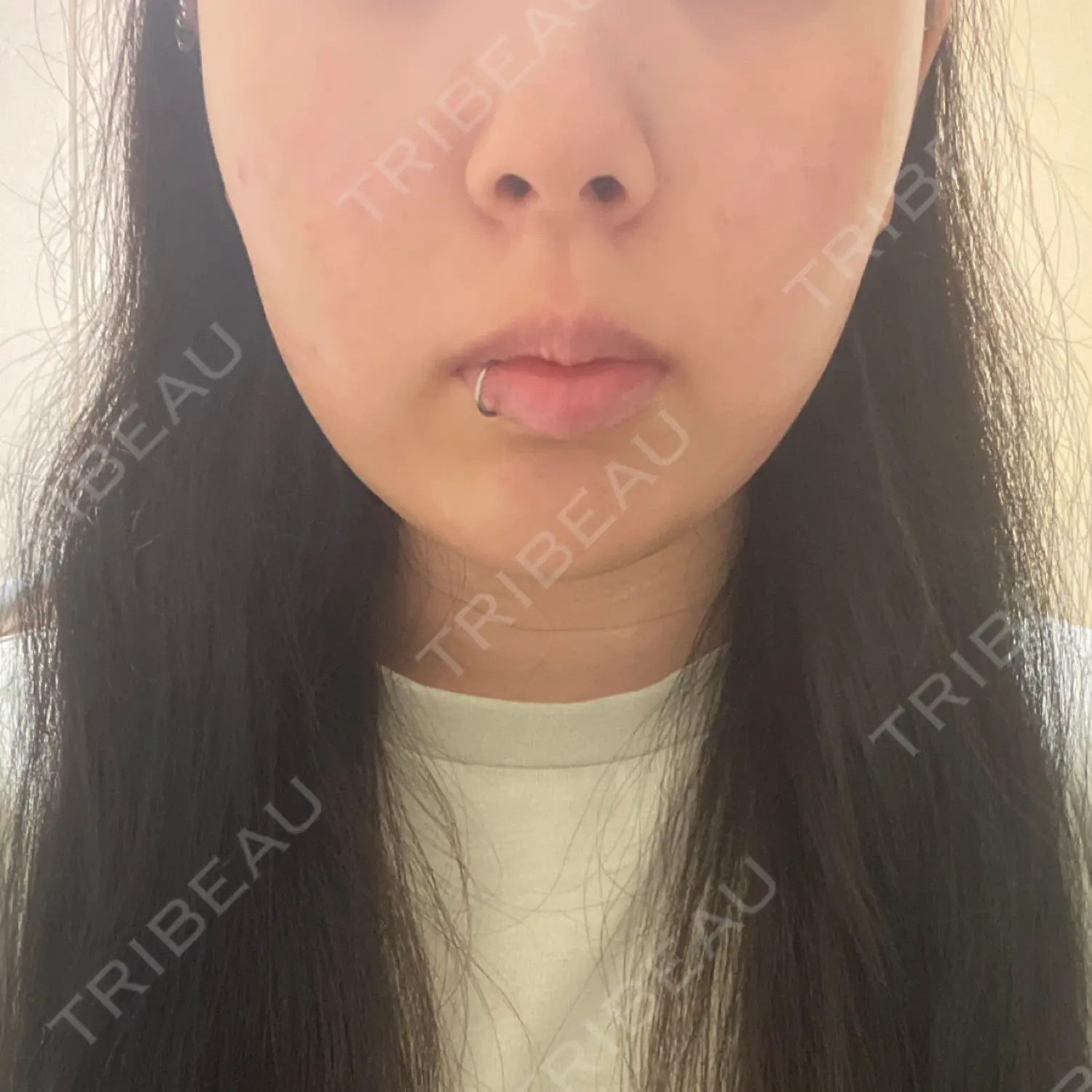 施術後の写真