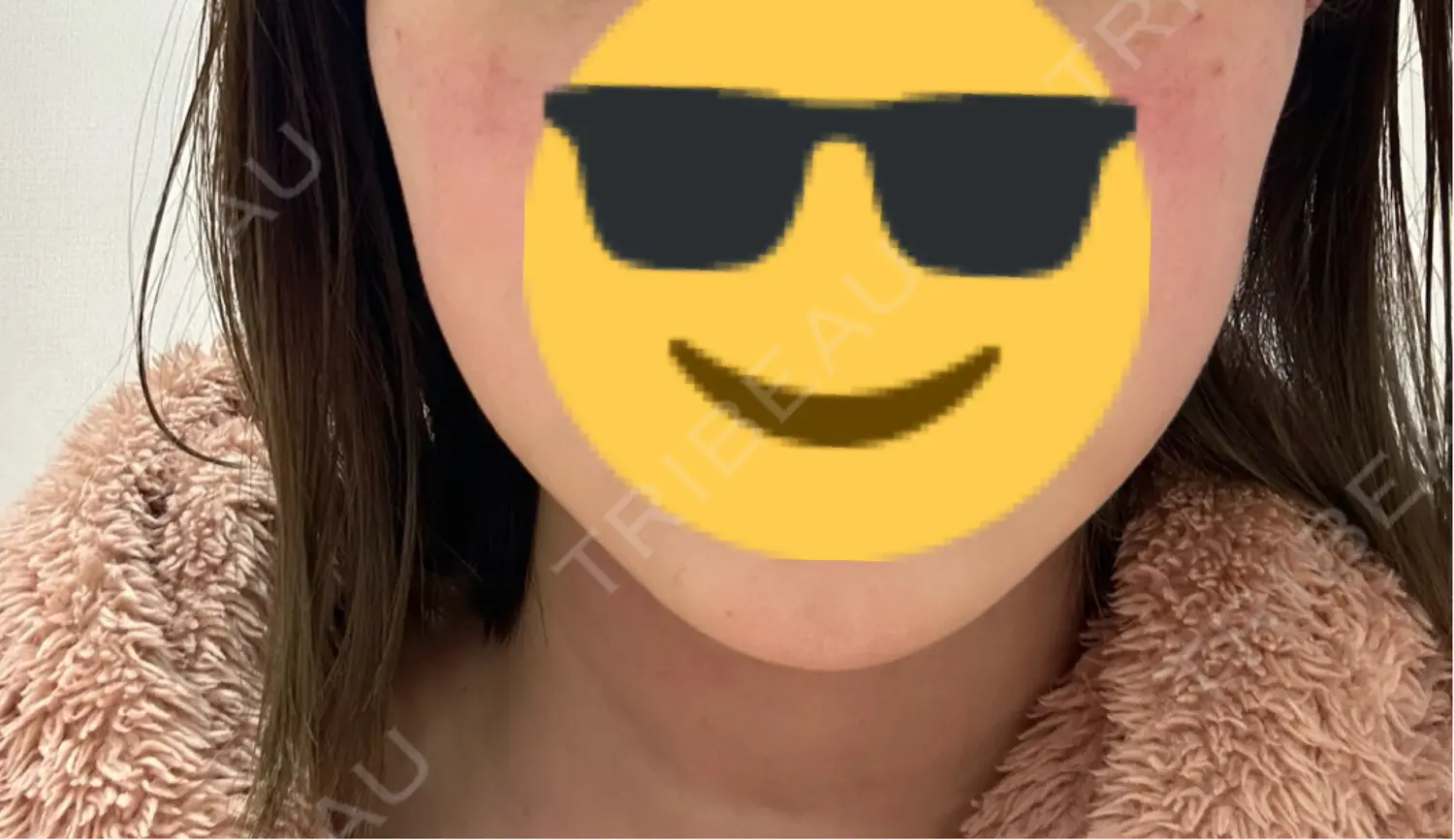 施術後の写真