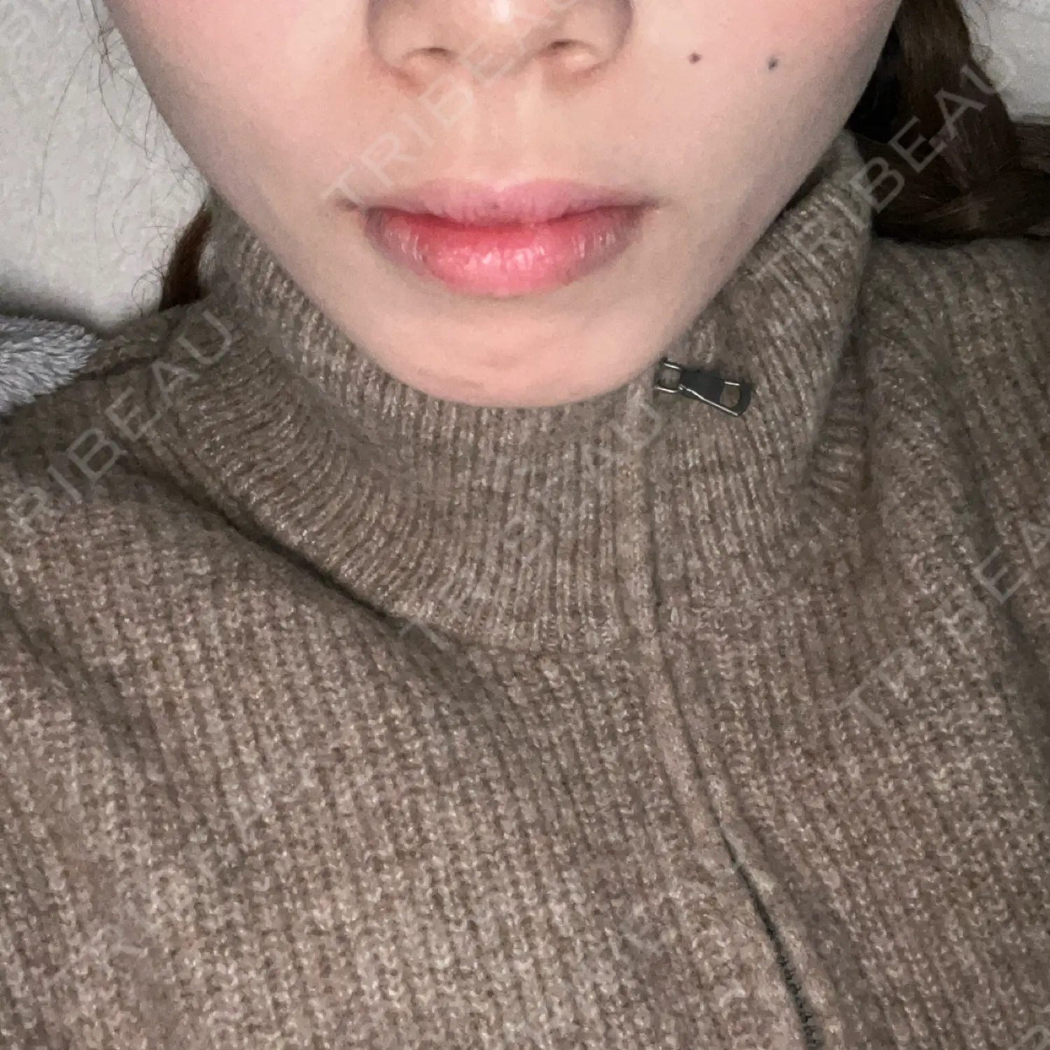 施術後の写真