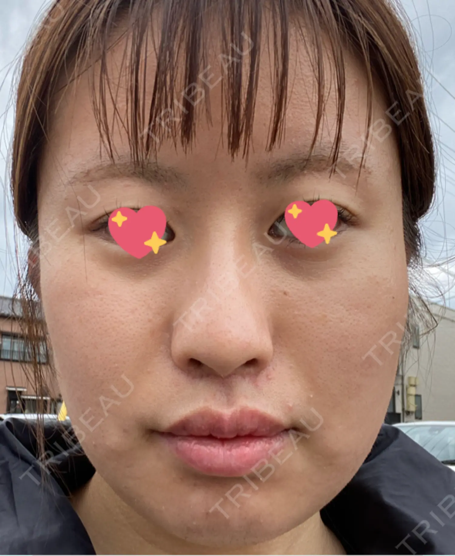 施術後の写真