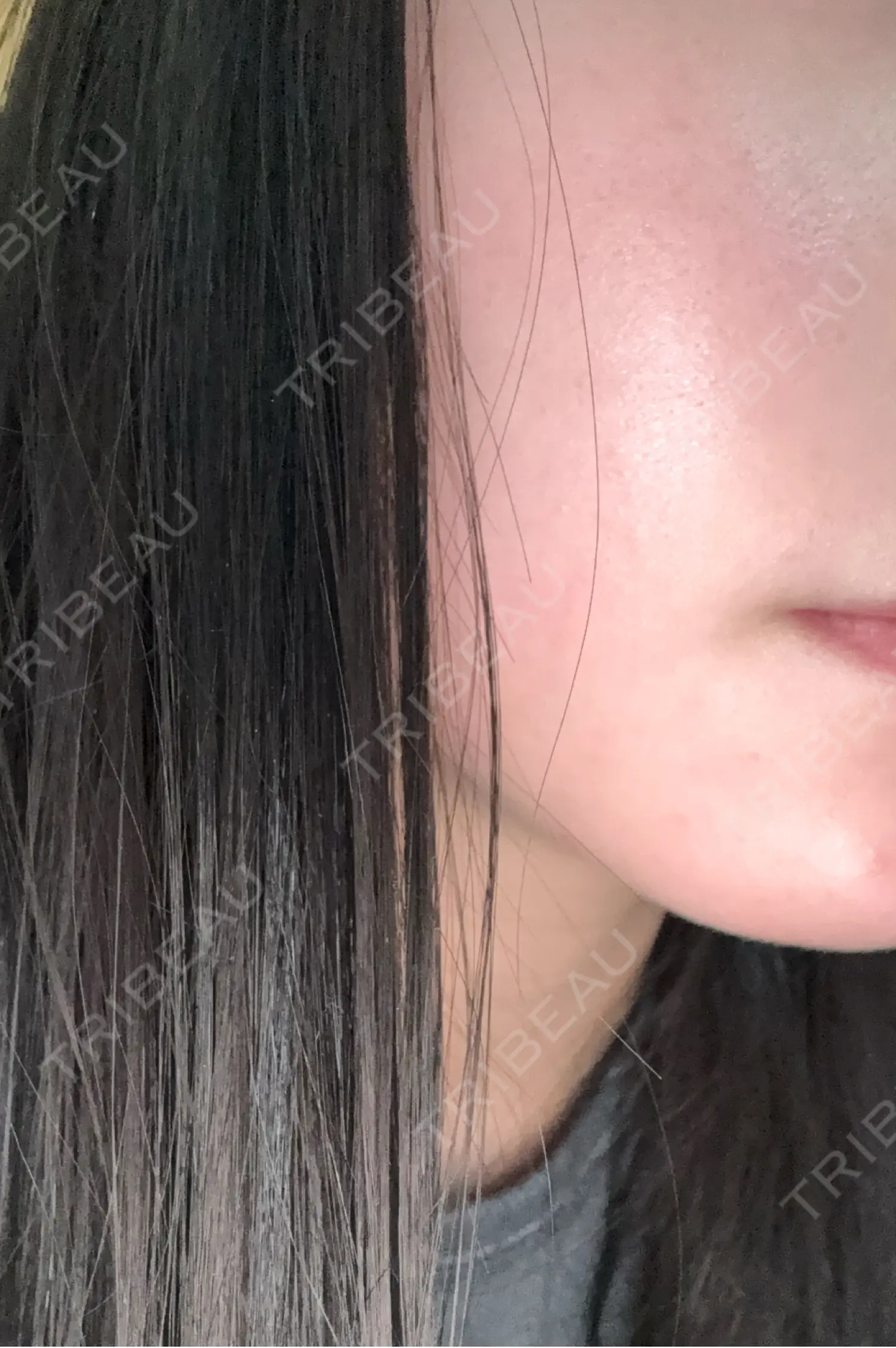 施術後の写真