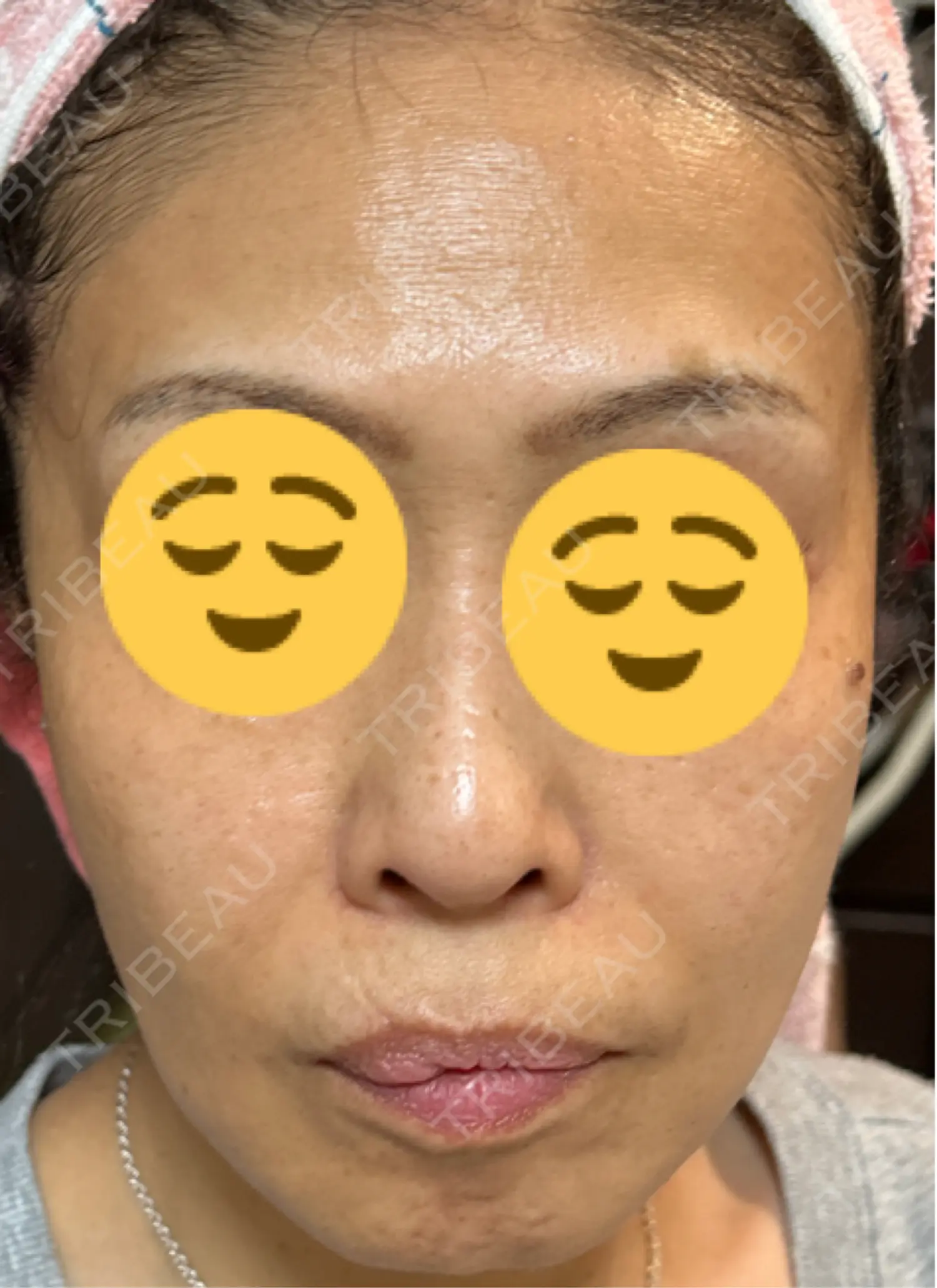 施術後の写真