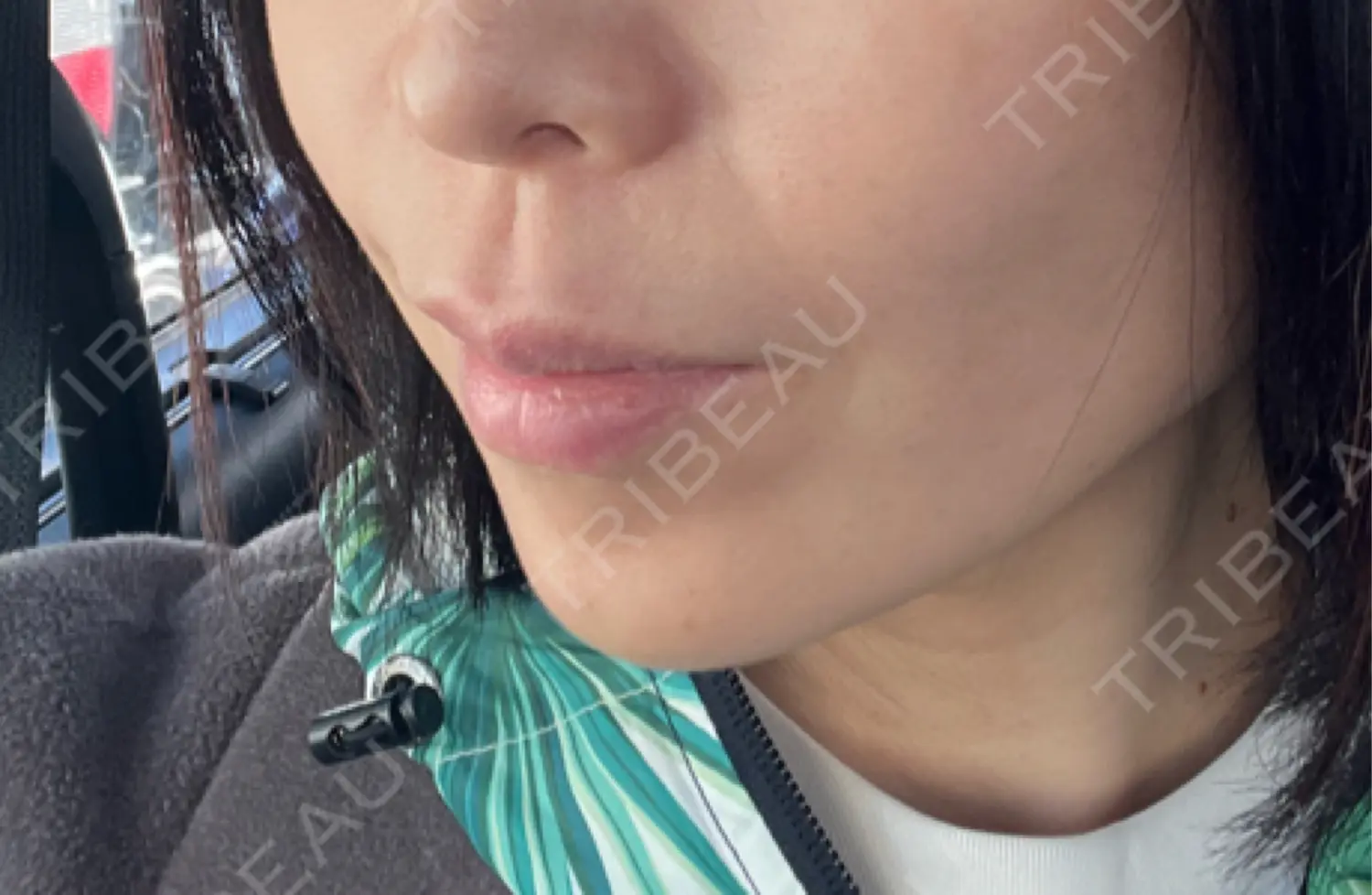 施術後の写真