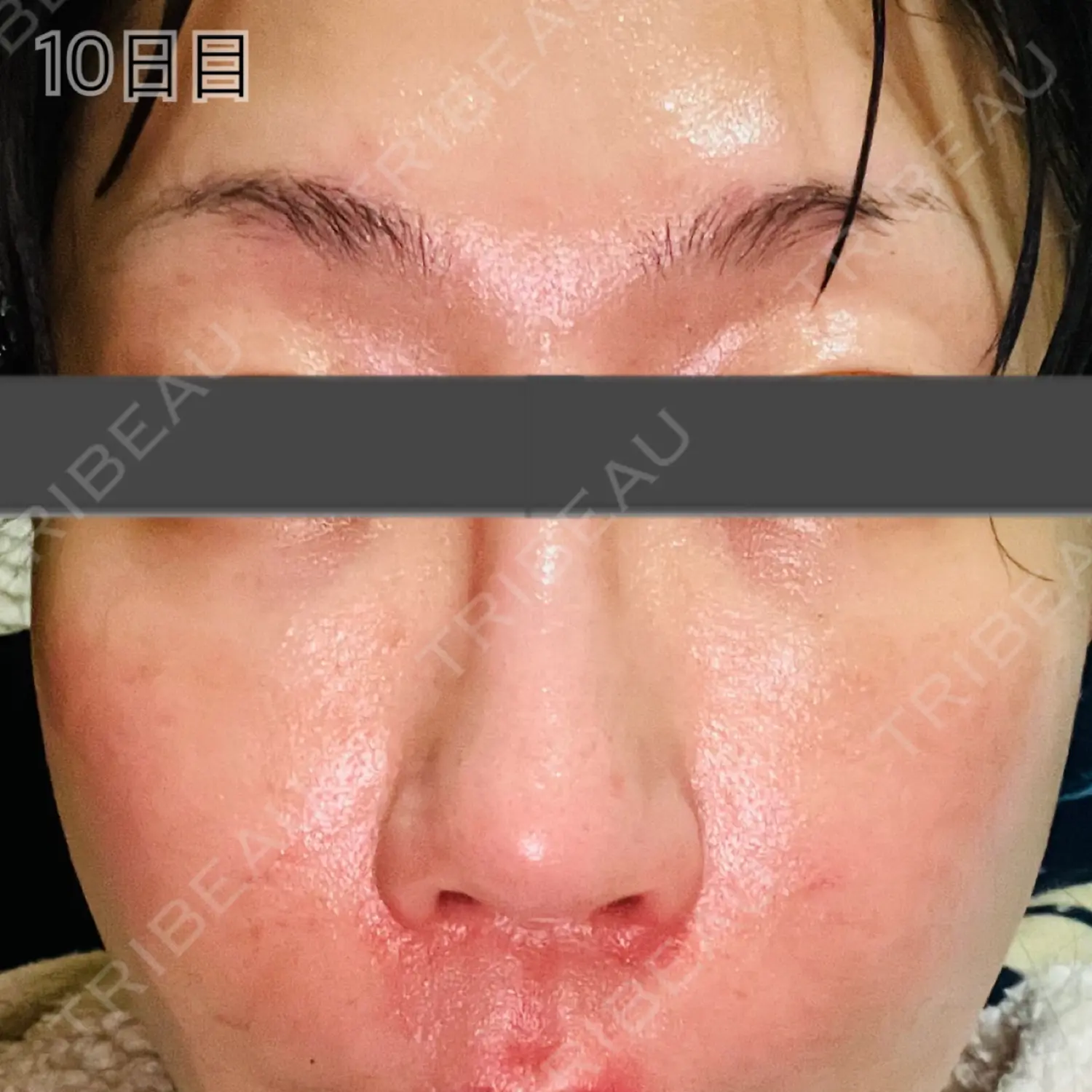 施術後の写真
