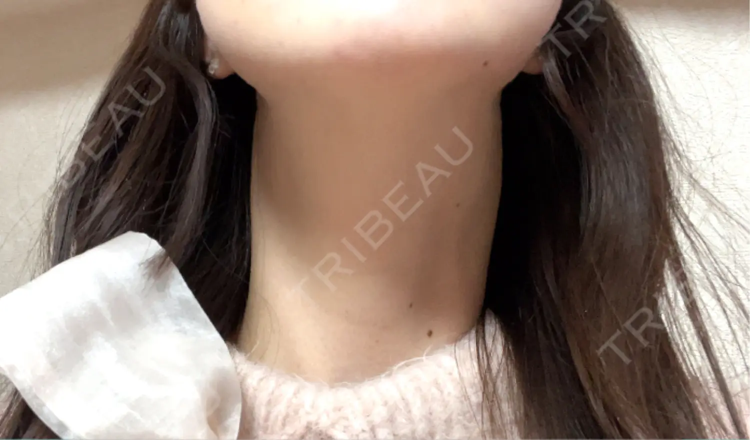 施術後の写真