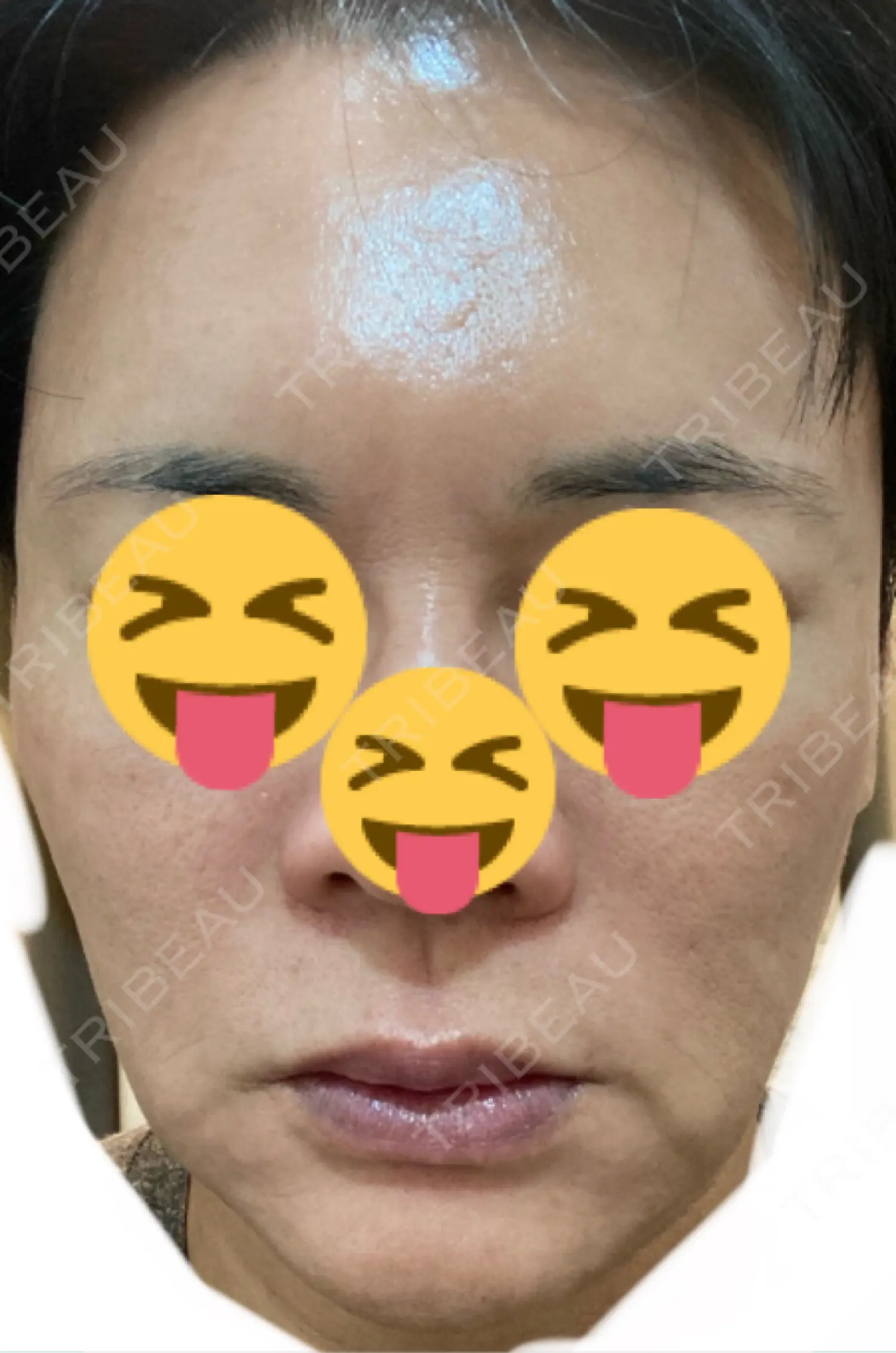 施術後の写真