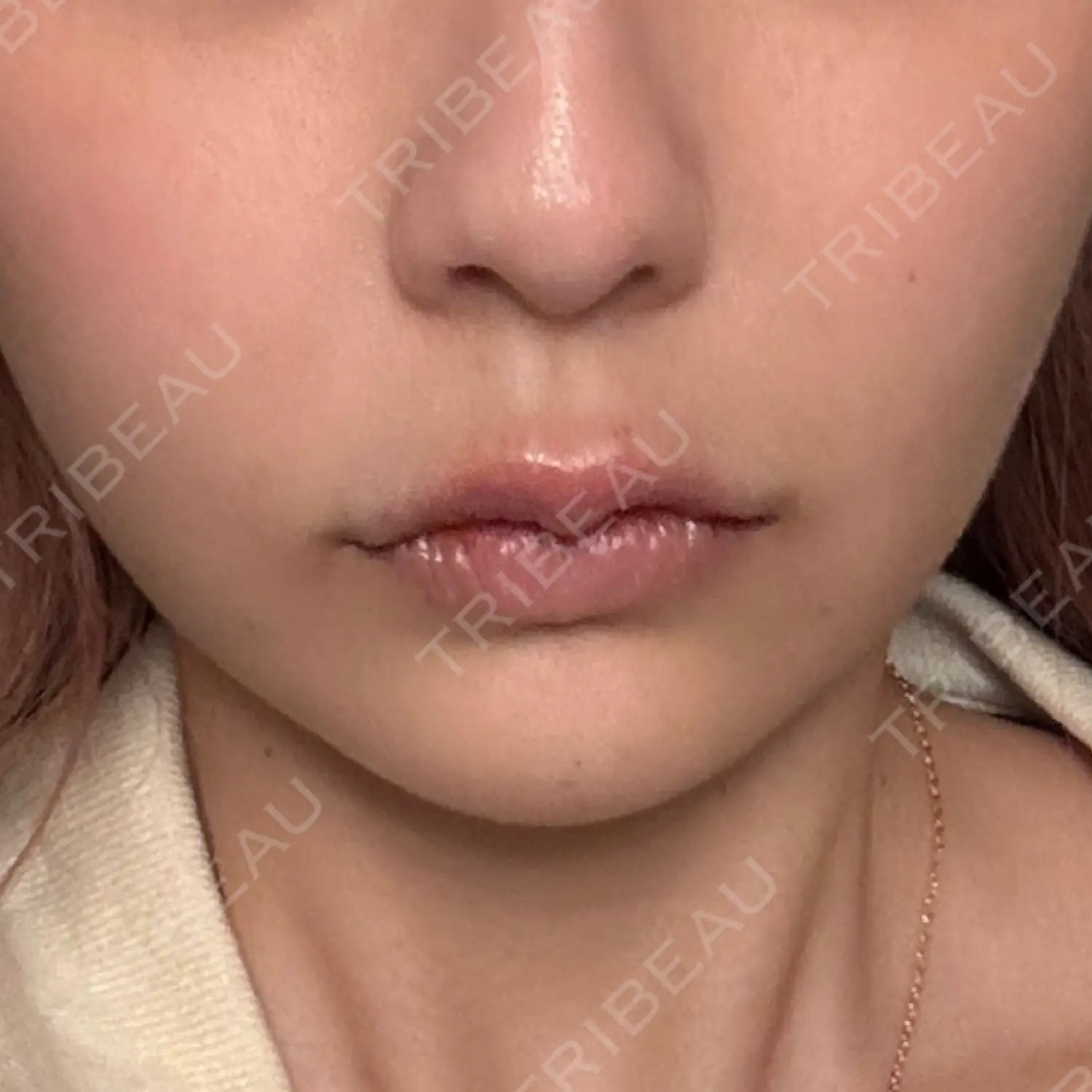 施術後の写真