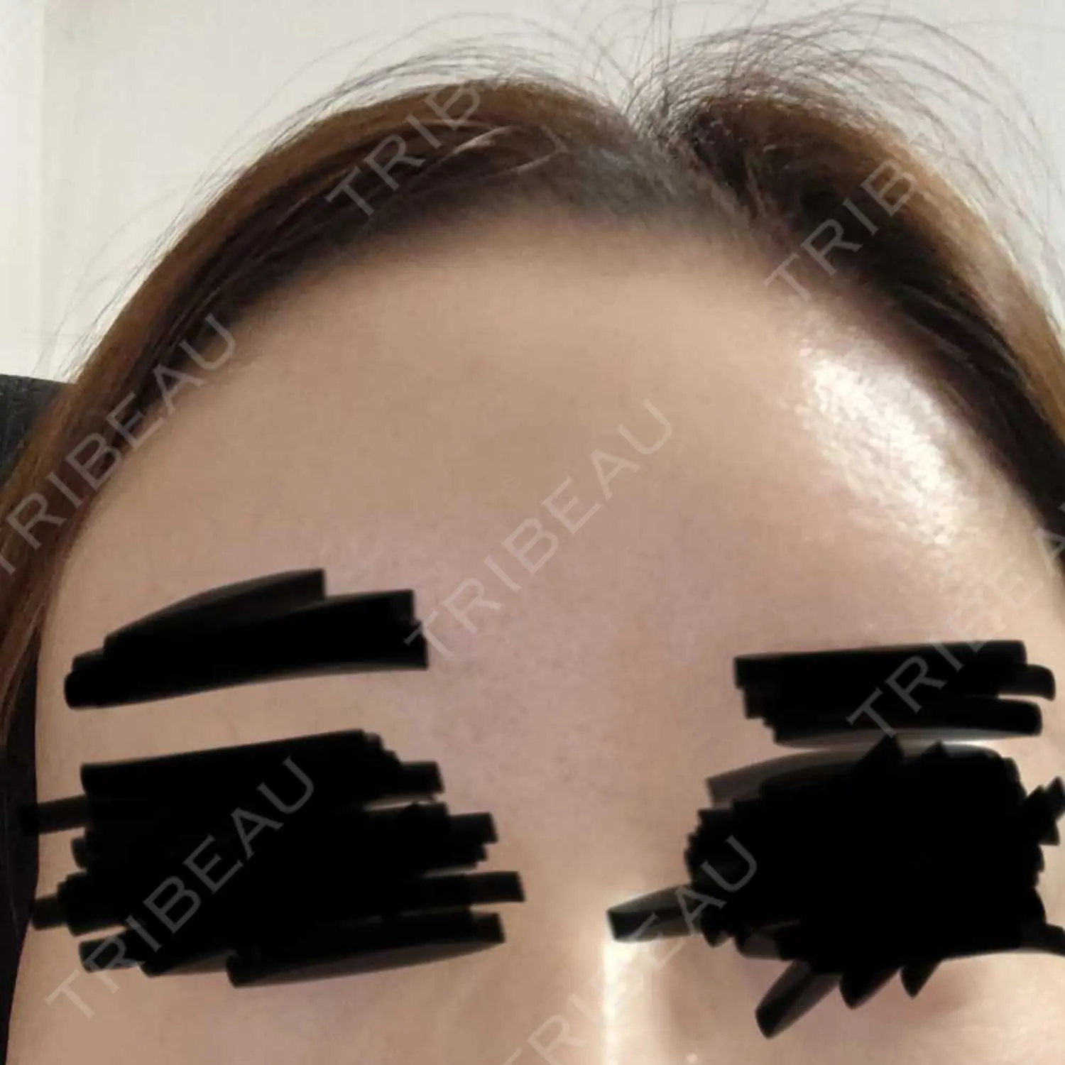 施術後の写真