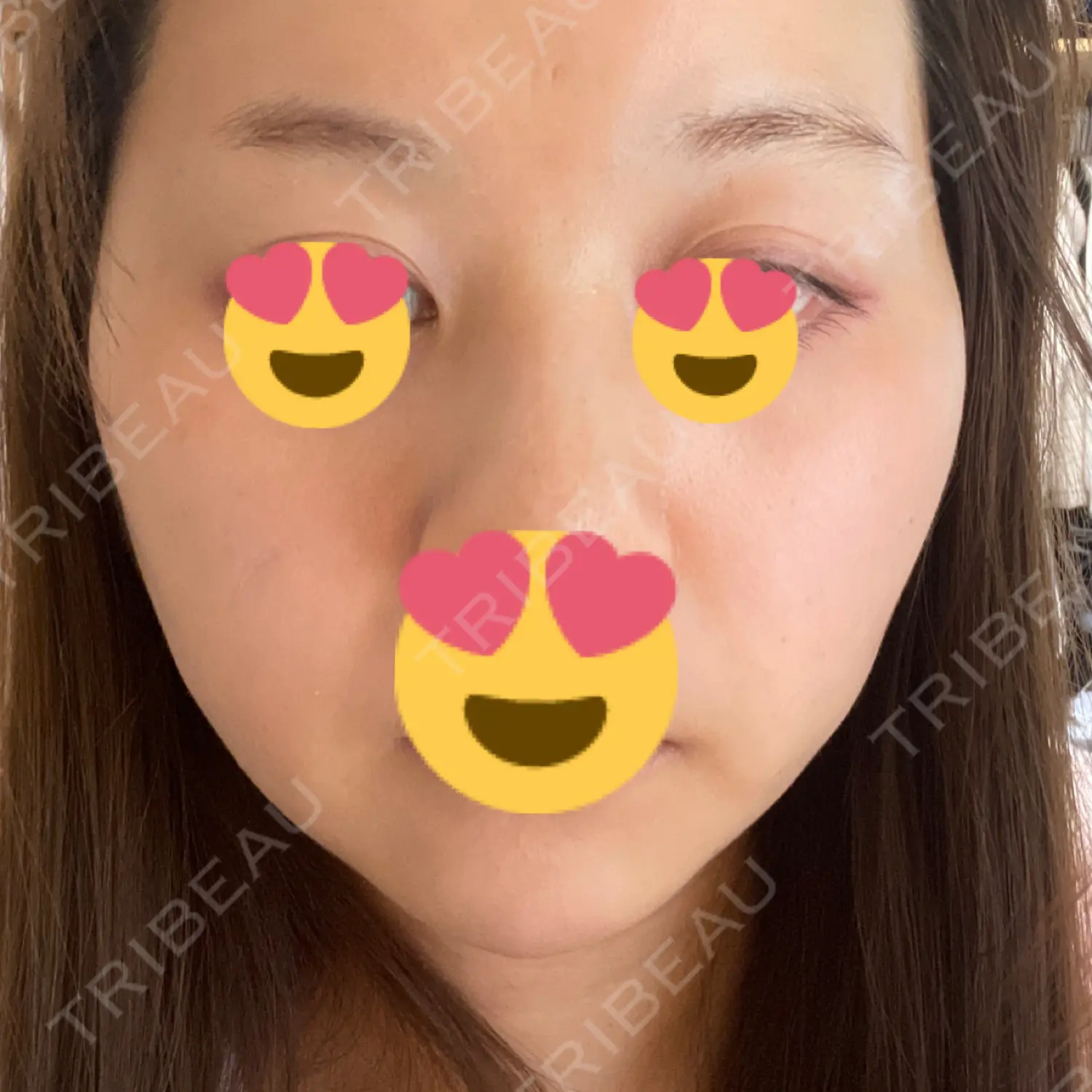 施術後の写真