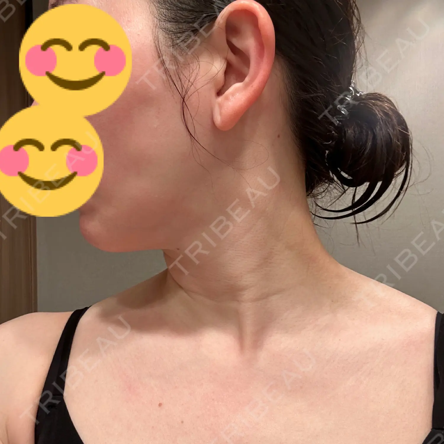施術後の写真