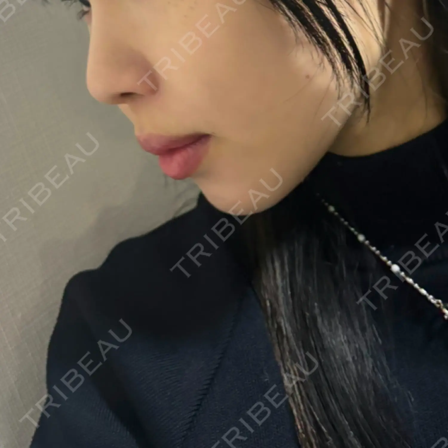 施術後の写真