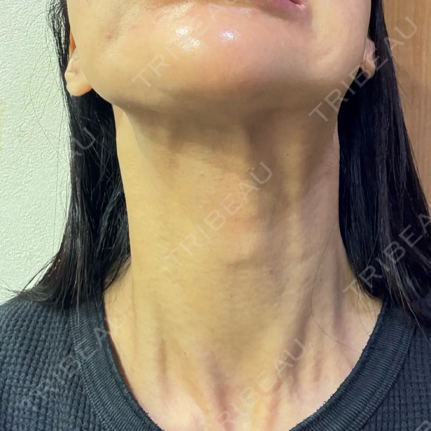 施術後の写真
